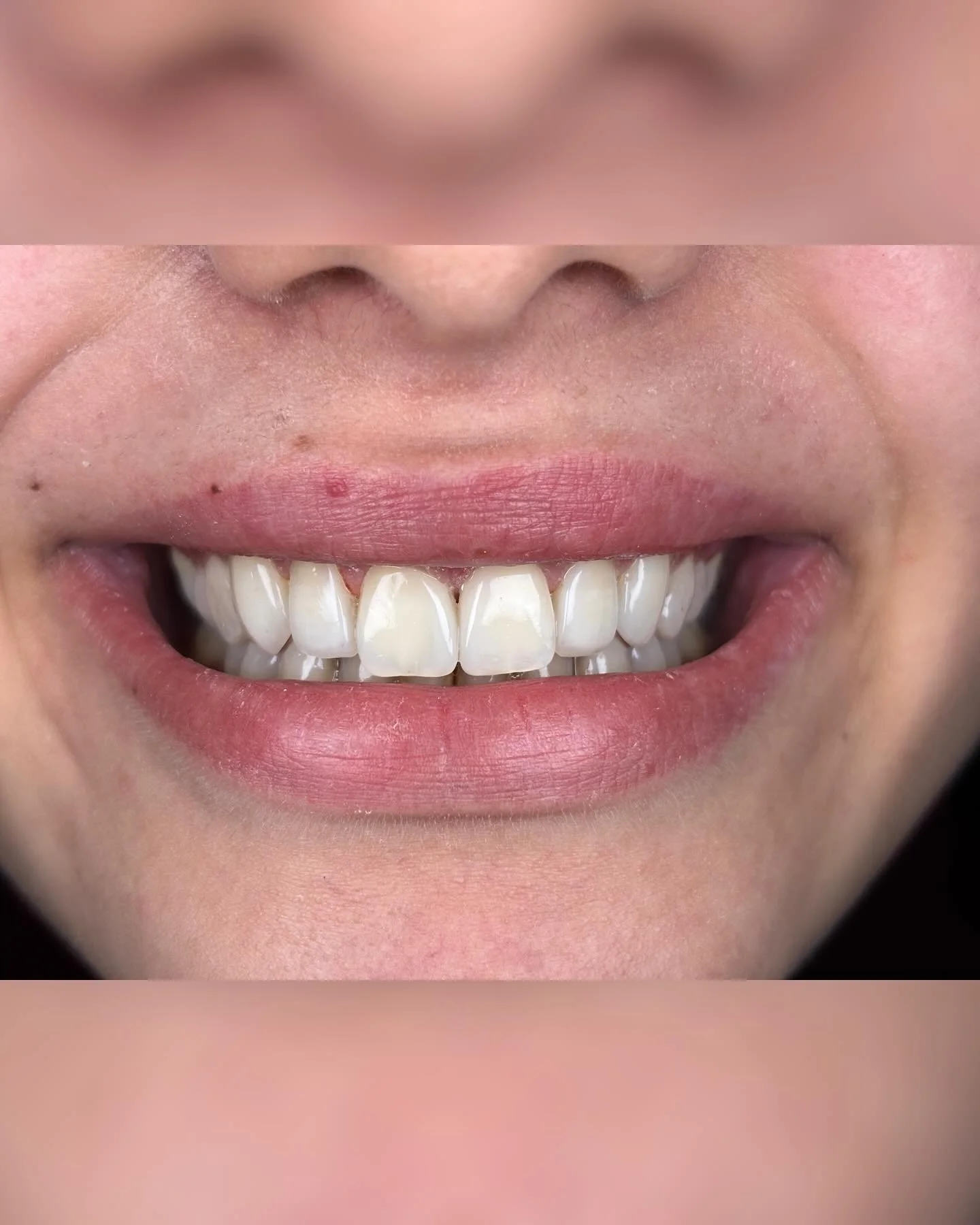 Dişlere herhangi bir aşındırma yapmadan free hand yaptığım kompozit laminalar 😊 t&uuml;m işlem 2,5 saat s&uuml;rd&uuml; 💎. 
Tokuyama asteria we a1b @tokuyamaturkiye 
#kompozitlamina #smiledesign #bonding #istanbuldişhekimi