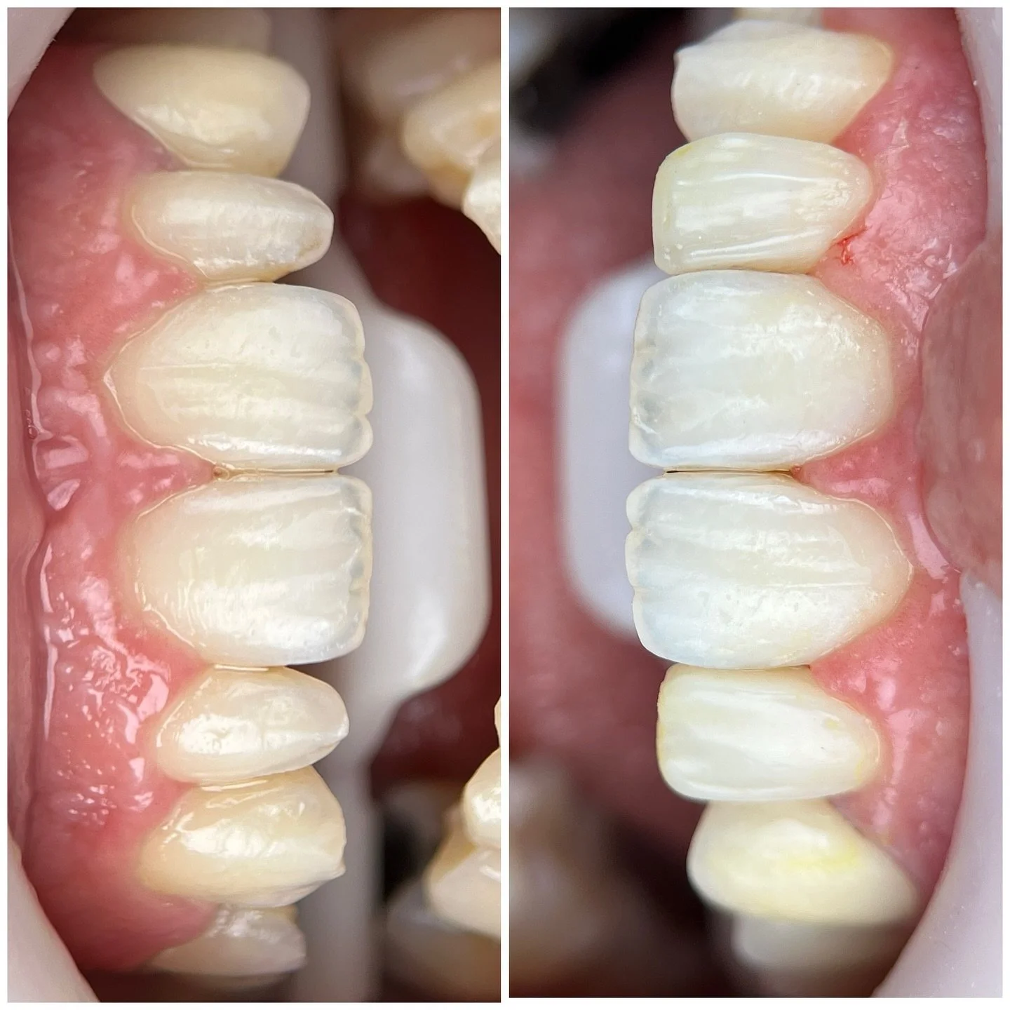 Diş teli sonrası k&uuml;&ccedil;&uuml;k olan lateral dişlerin kompozit ile b&uuml;y&uuml;t&uuml;lmesi.
Kullanılan materyal:Asteria A1b @tokuyamaturkiye