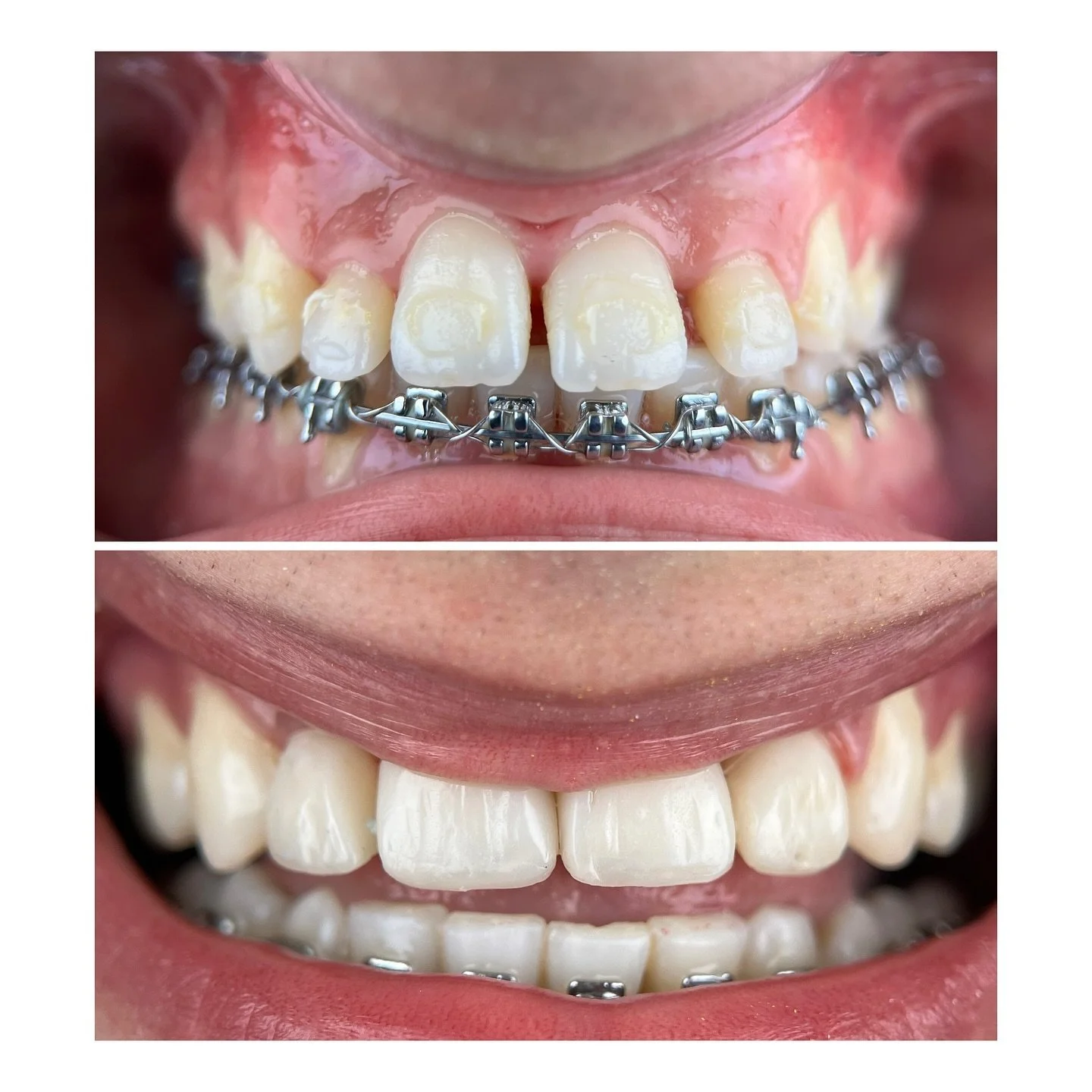 Haftayı bu zorlu vakayla kapıyoruz 💪🏻

Alt &ccedil;enedeki bolton fazlalığından dolayı geniş diestemalar, orta hattın 1 mm sağda olması, olduk&ccedil;a prokline lateraler&hellip;
Hepsi kompozit laminelerle bir seansta halloldu 🤗