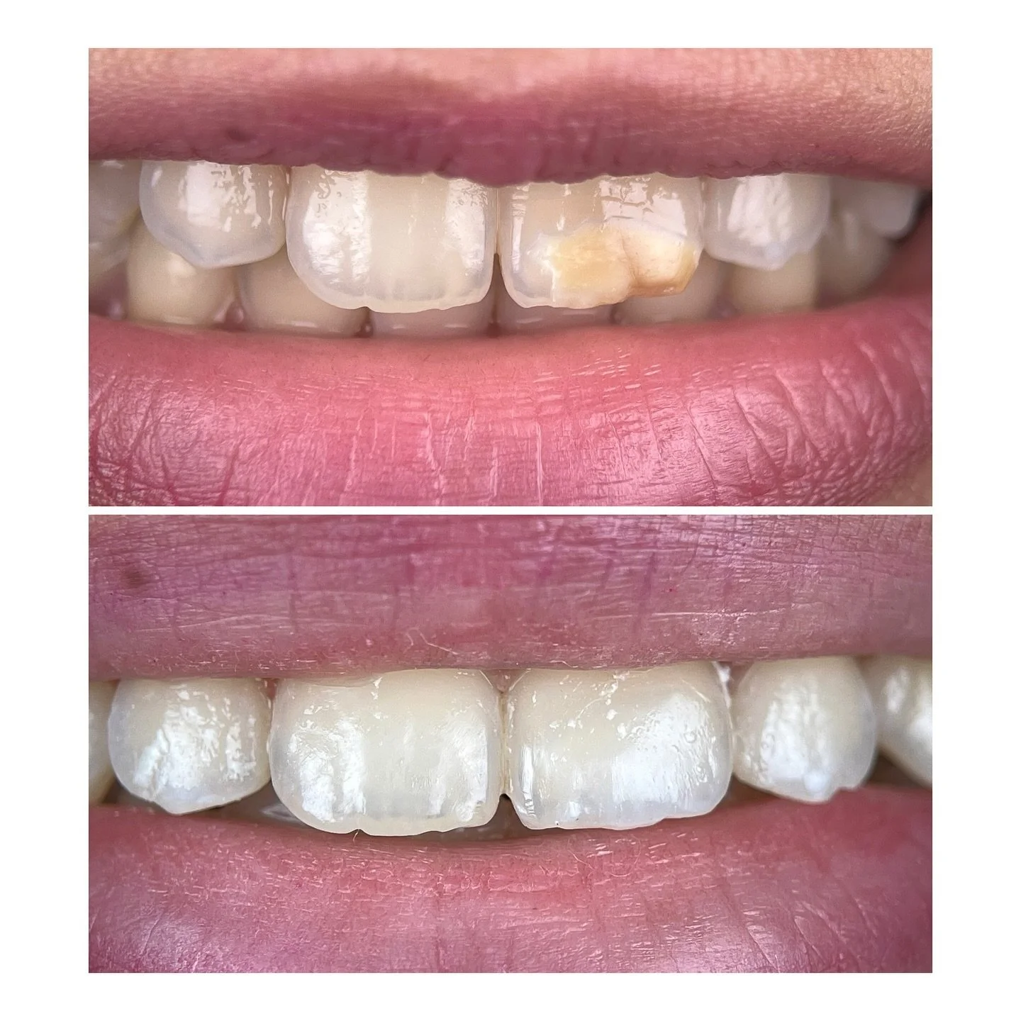 Kompozit lamina☺️

İkinci fotoğraf işlemden hemen sonra dişler hen&uuml;z dehidreyken 1. ve 3. fotoğraflar kontrol seansında renk oturduktan sonra &ccedil;ekildi 📸

Kullanılan dolgular : estelite asteria A1B, WE  @tokuyamaturkiye