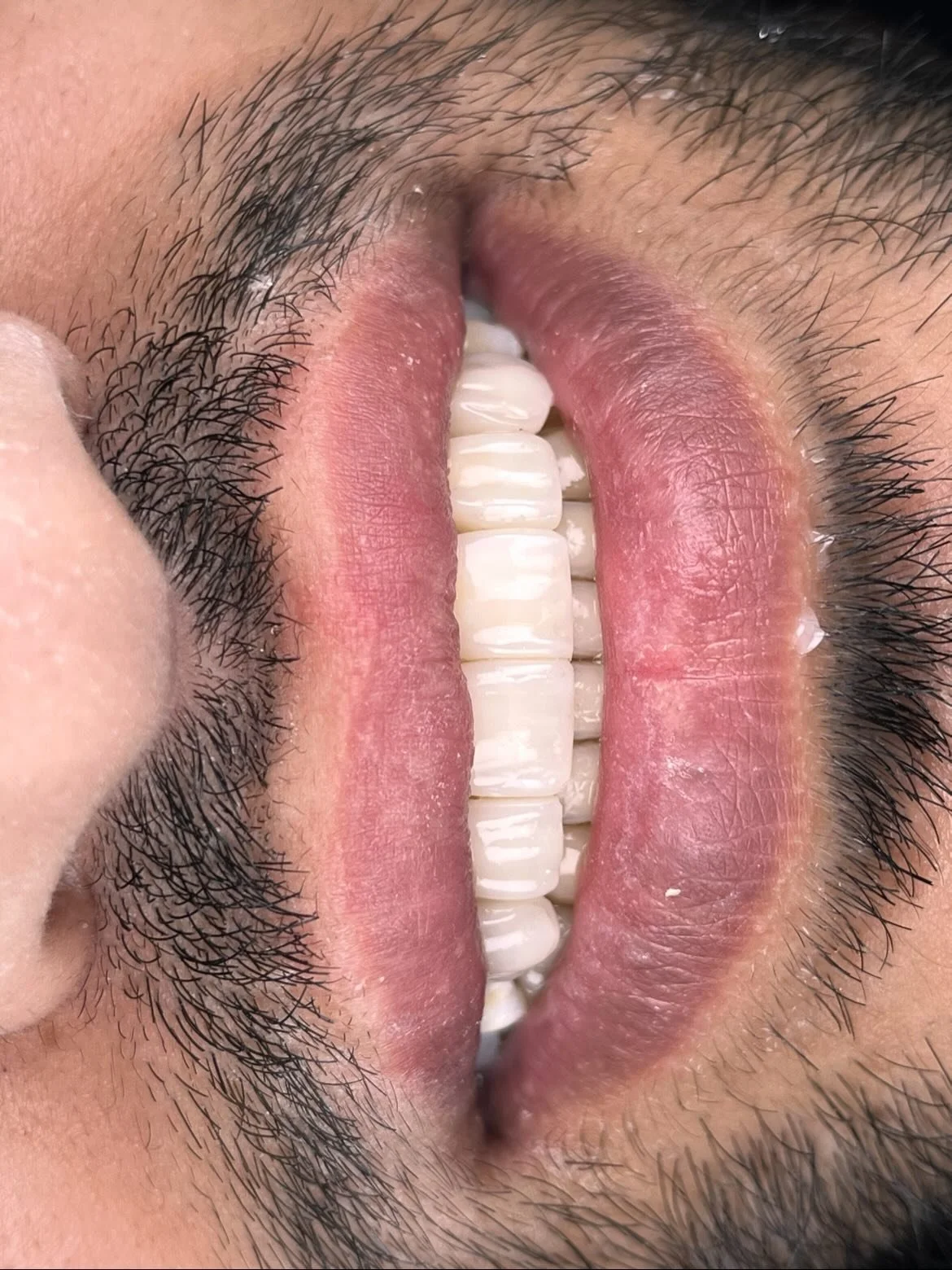 Bu işlem yapılırken hastanın kendi dişlerine herhangi bir aşındırma yapılmamıştır.
Fuarda bu vakayı @dr.amirbadalihaghi hoca ile değerlendirdiğimizde Saremco IB nin &ccedil;ok iyi gideceğini s&ouml;ylemişti ve &ouml;yle de oldu 🔥 Saremco IB @saremco