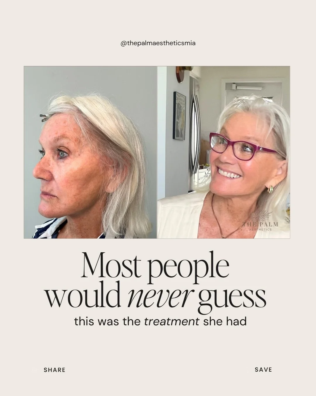 Most people would never guess this was the treatment she had.

When Botox is done well, people don&rsquo;t usually think, &ldquo;She had Botox.&rdquo;

They notice that you look well-rested.
They notice smoother skin.
They notice something looks diff