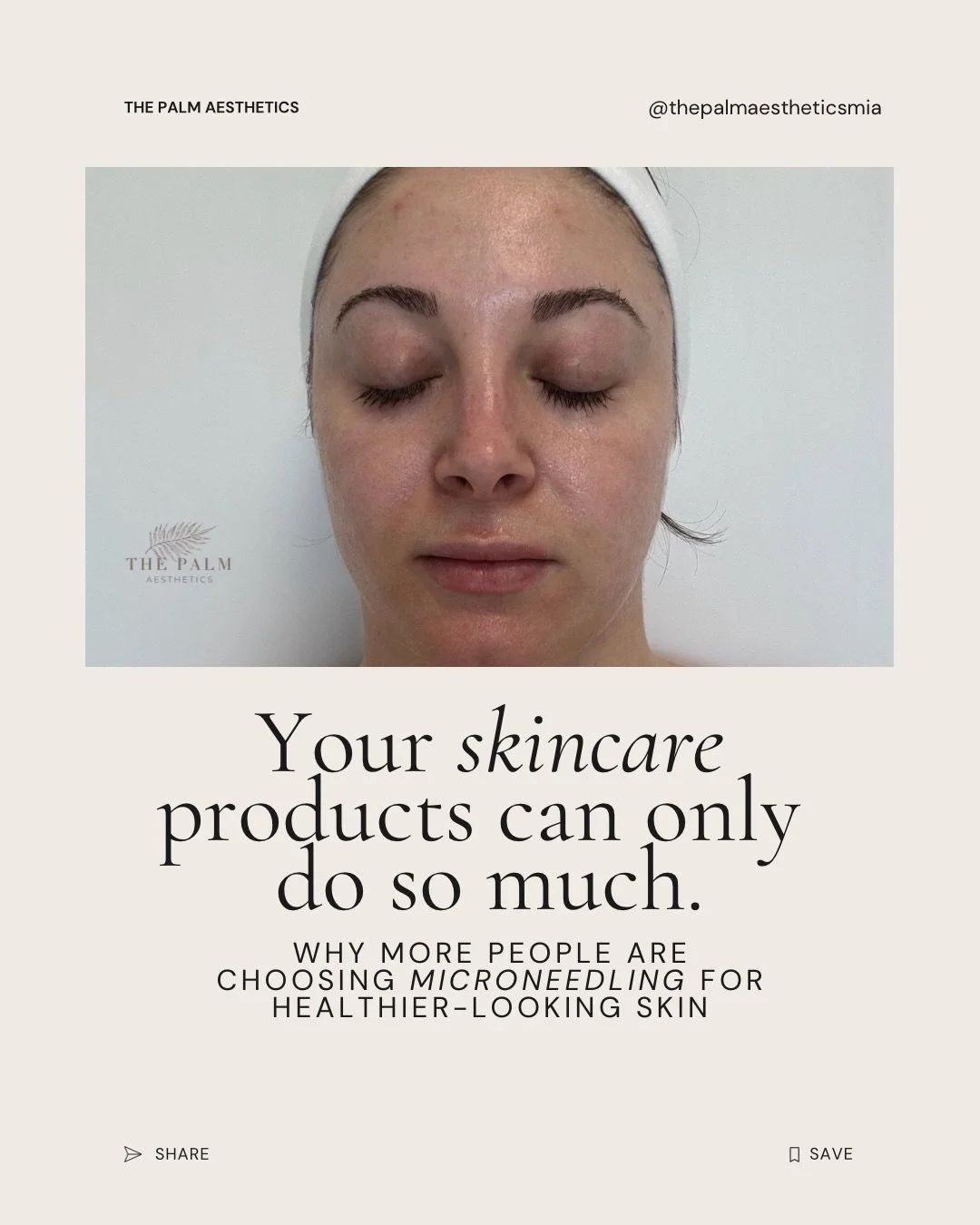 At some point, a lot of people notice their skin just doesn&rsquo;t bounce back the same anymore.

Less glow. More texture. Makeup suddenly looking different no matter how much skincare you buy.

That&rsquo;s why so many people turn to microneedling 