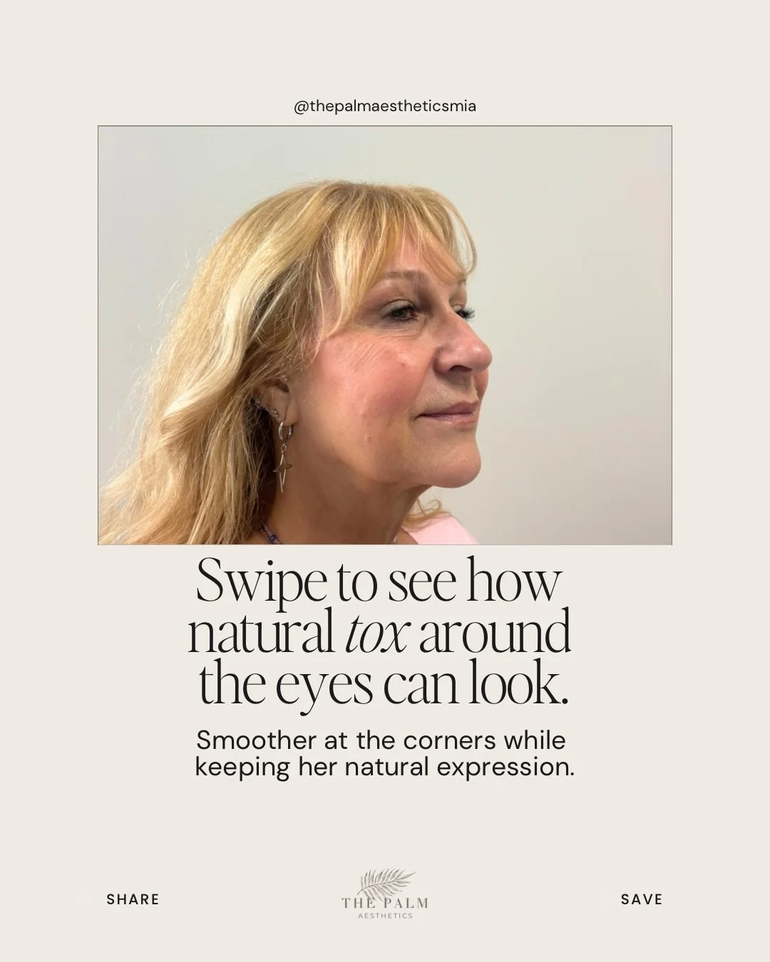 The part that makes crow&rsquo;s feet tox look natural happens before the needle ever touches your skin.

Ed first looks at how the muscles around your eyes move. That helps him decide where to place the tox and how much to use for your anatomy.

Bec