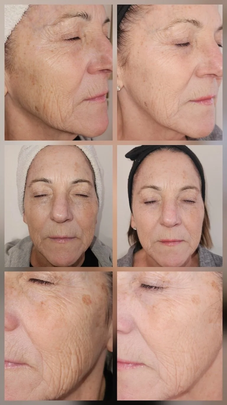 Before and after images of a woman's face showing skin improvements, with close-ups of her cheek and eye areas. The photos display reduction in wrinkles and age spots, indicating skincare or cosmetic treatment results.