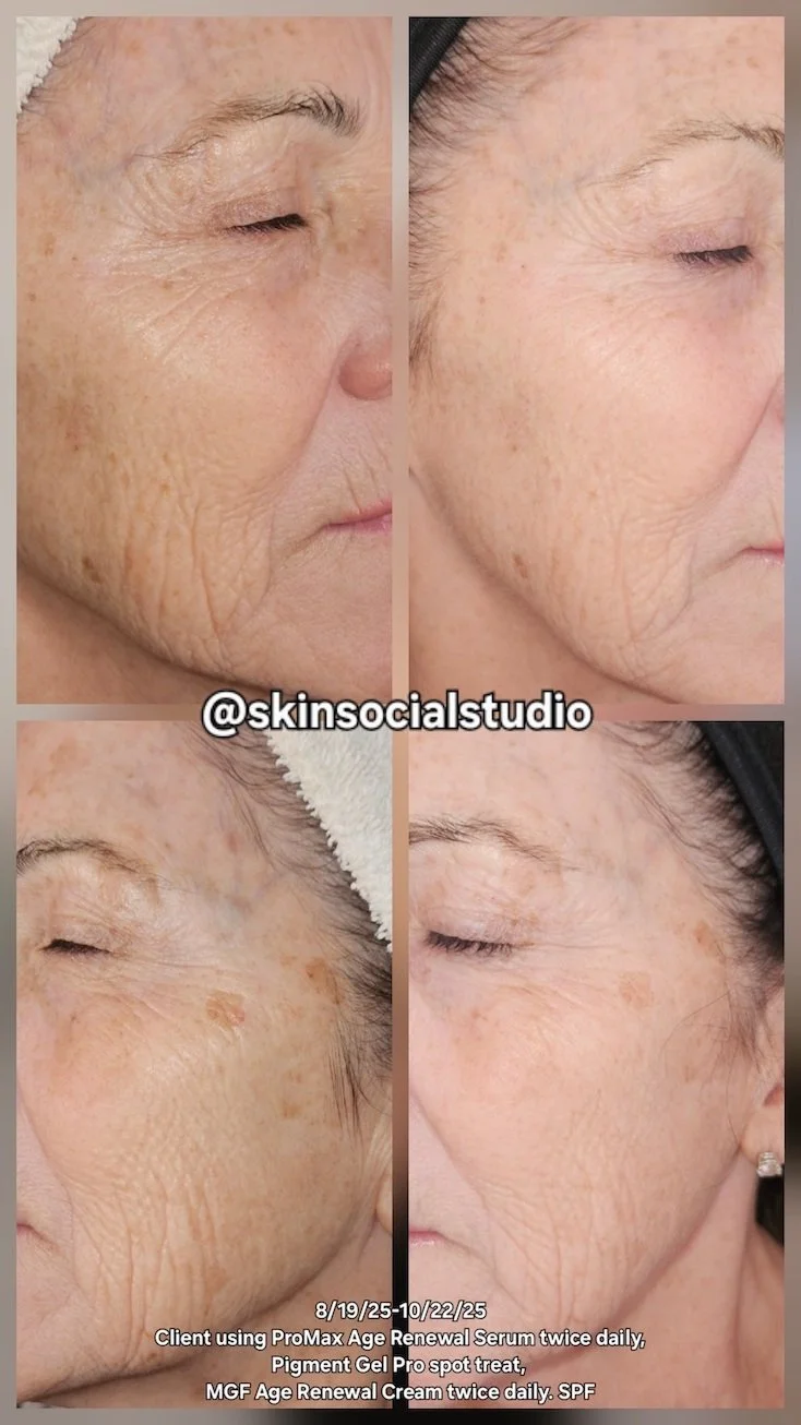 Before and after close-up photos of an elderly woman's face showing skin improvement with anti-aging treatments including ProMax Age Renewal Serum, Pigment Gel Pro, and MGF Age Renewal Cream.