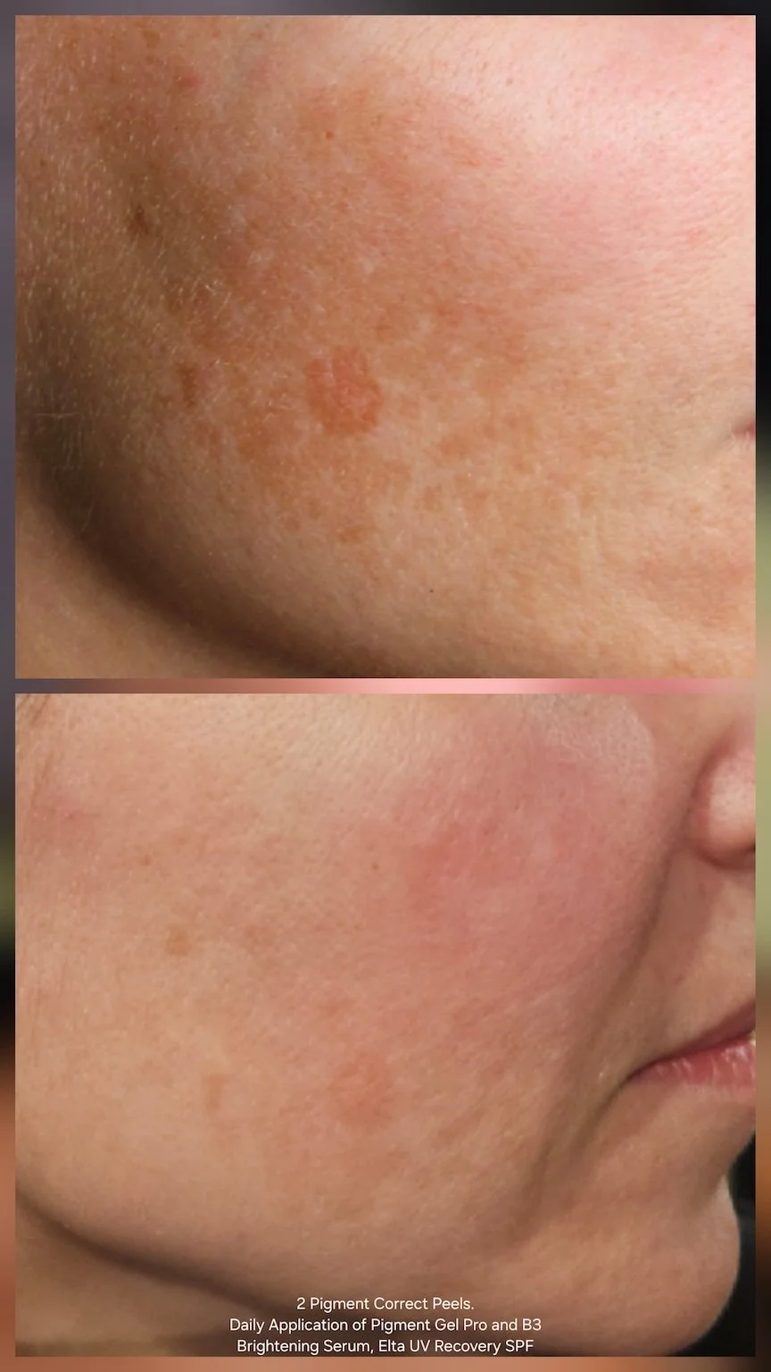 Close-up comparison of skin before and after using skincare products, showing improved skin texture and tone.