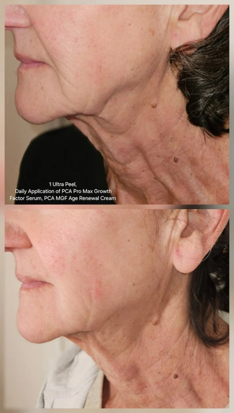 Comparison of a woman's jawline and neck showing before and after skin treatment, with noticeable improvement in skin tightness and texture.