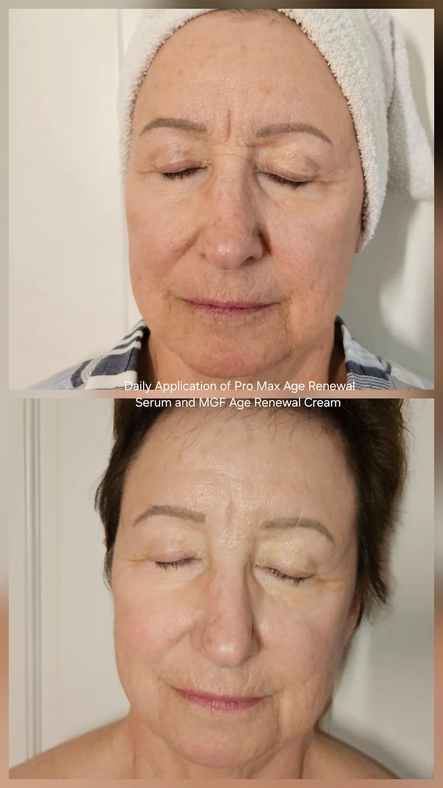 Side-by-side comparison of a woman before and after applying Pro Max Age Renewal serum and MGF Age Renewal Cream, showing improved skin appearance.