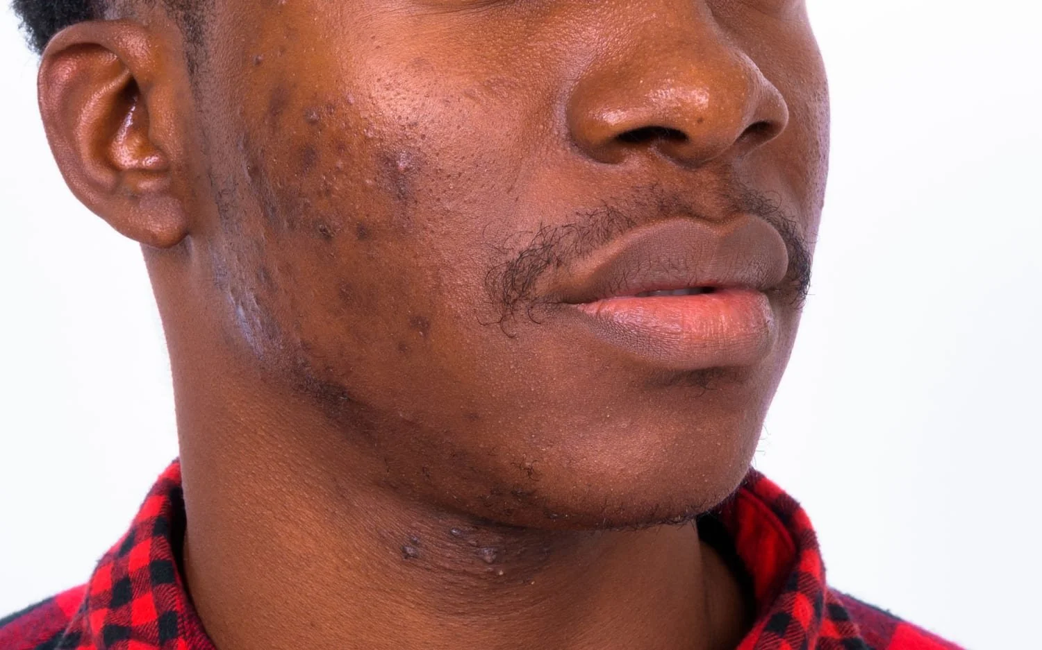 Medspa in Millbrae, CA, 94030 |  AviClear Laser for Acne Near Me