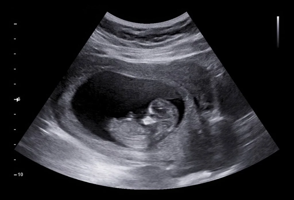 Personhood Begins at Conception: A Consistent Case Against Abortion