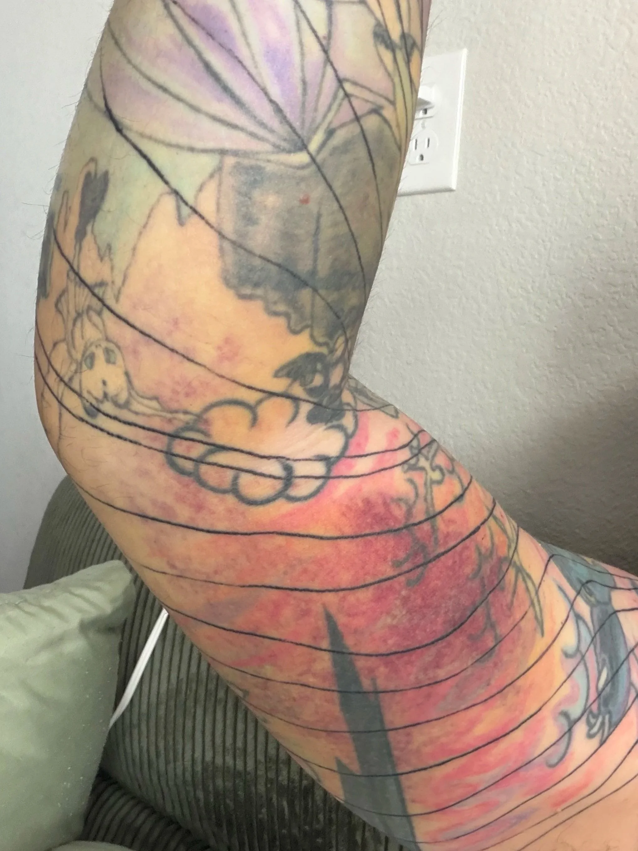 Day 6 of bruising