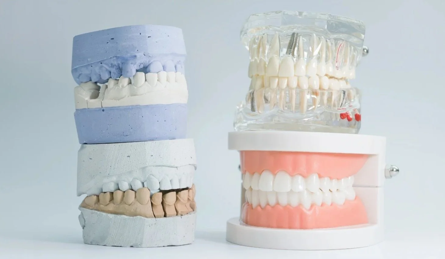 Two sets of dental models on a white surface, showcasing various dental prosthetics and orthodontic appliances.