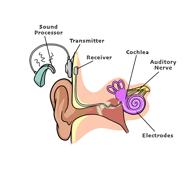 CochlearImplant_labeled_brain.png