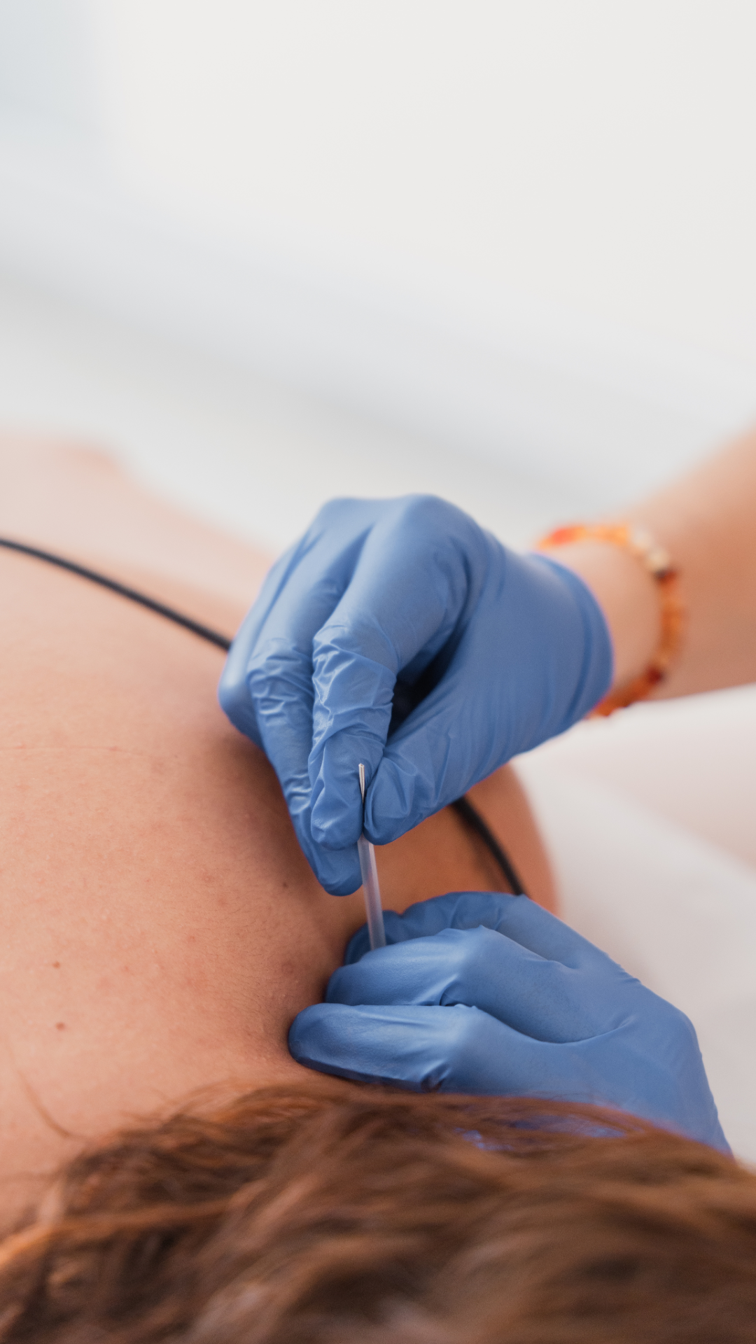dry needling of the shoulder