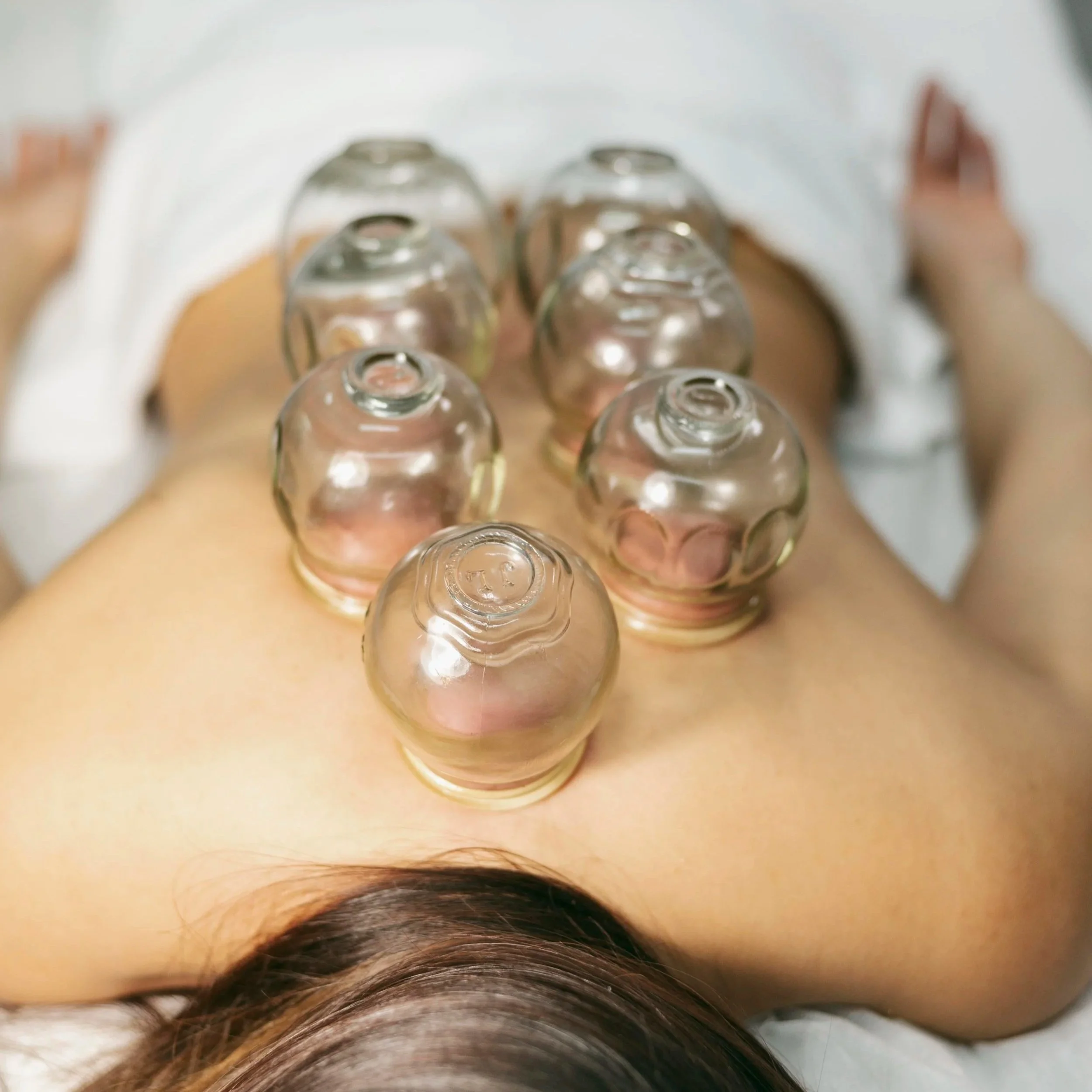 Person receiving fire cupping therapy on back