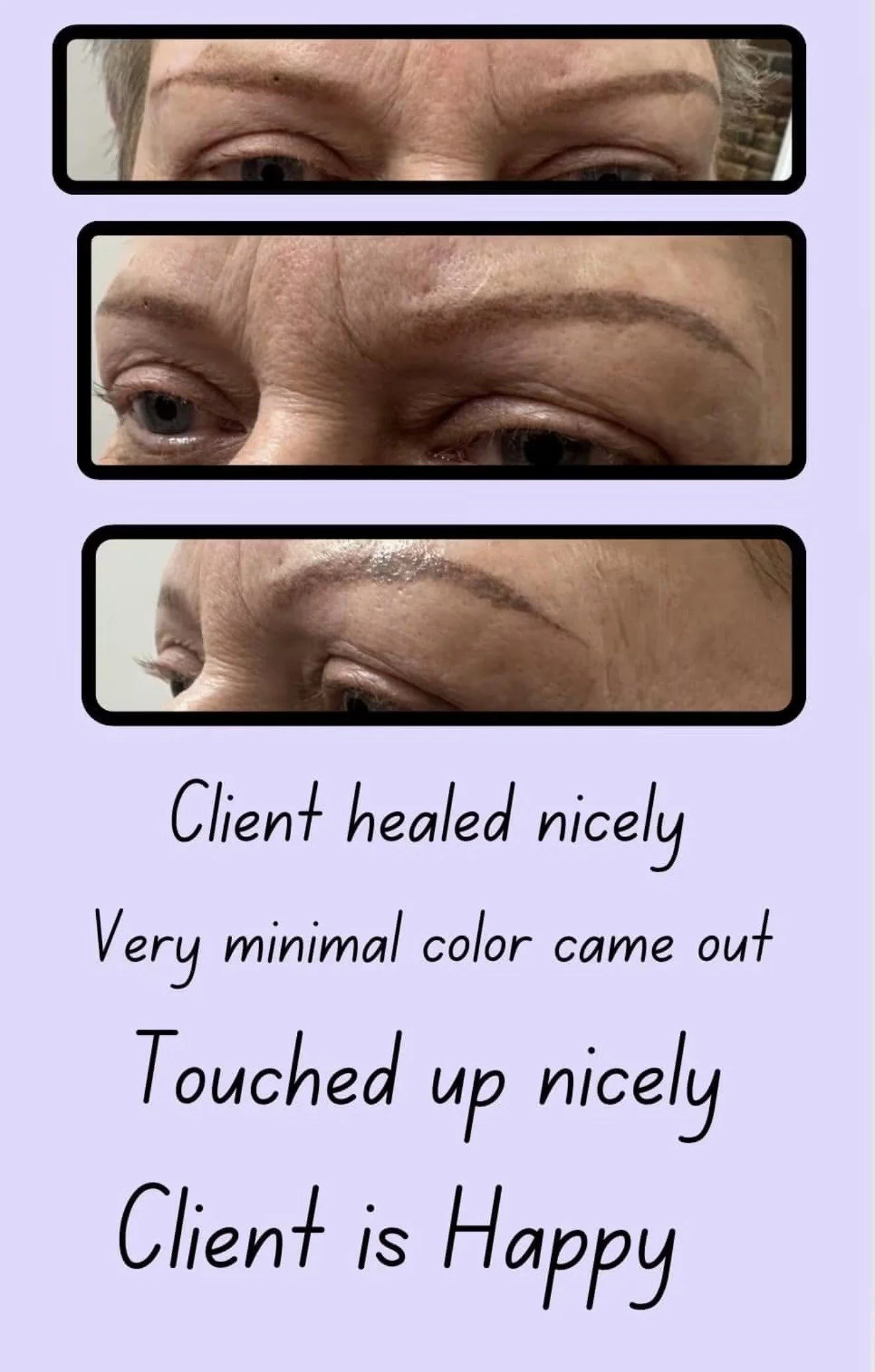 Eyebrow Before and After Healed 