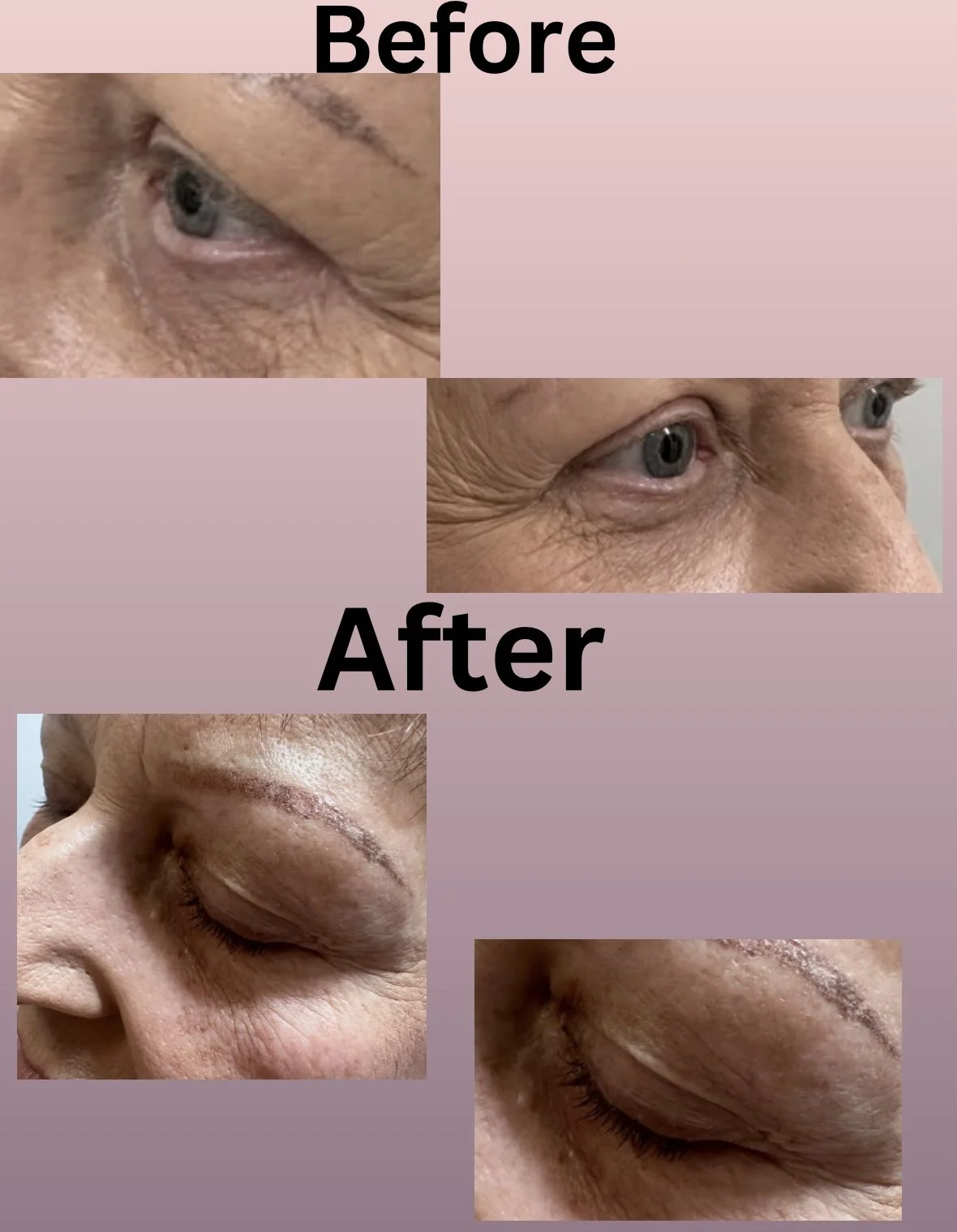 Comparison image showing a close-up of a person's eye area before and after a cosmetic procedure, highlighting reduced wrinkles and improved skin appearance.