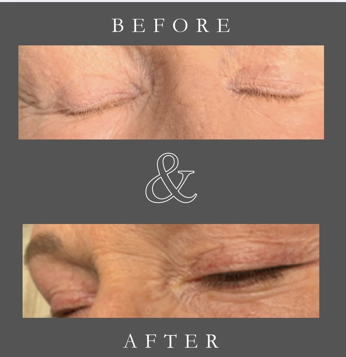 Eyeliner Tatoo Before and After