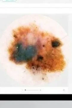 When to Worry About a Mole