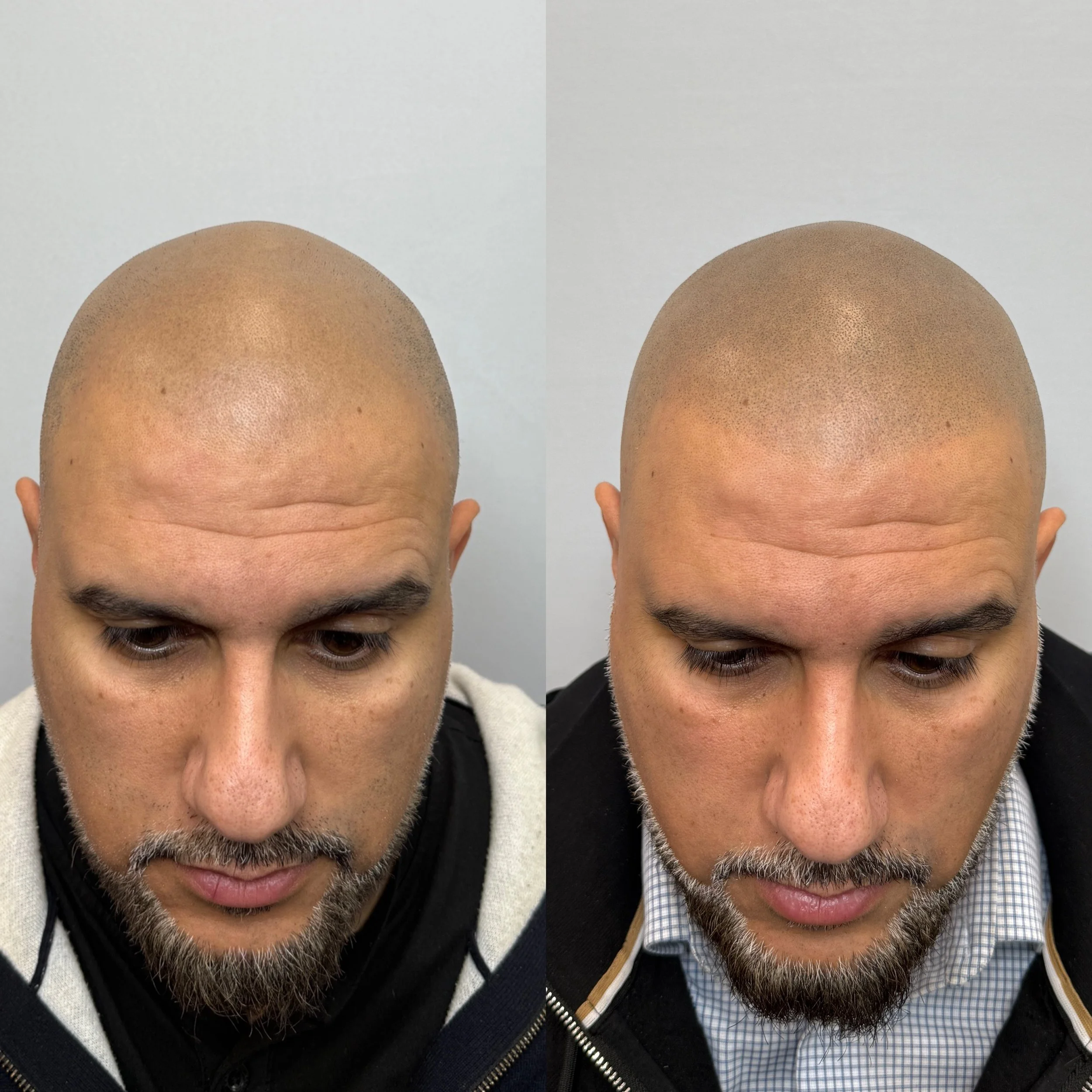 Close-up of two bald men's heads viewed from above, showing their foreheads and facial hair, against a plain light-colored background.