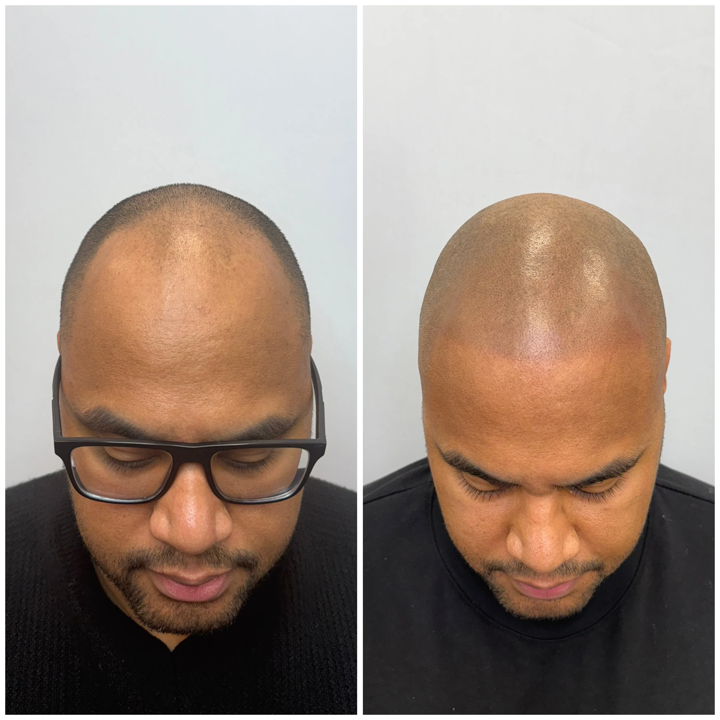 Comparison of the top of a man's head before and after a hair restoration procedure, showing fuller hair in the second image.