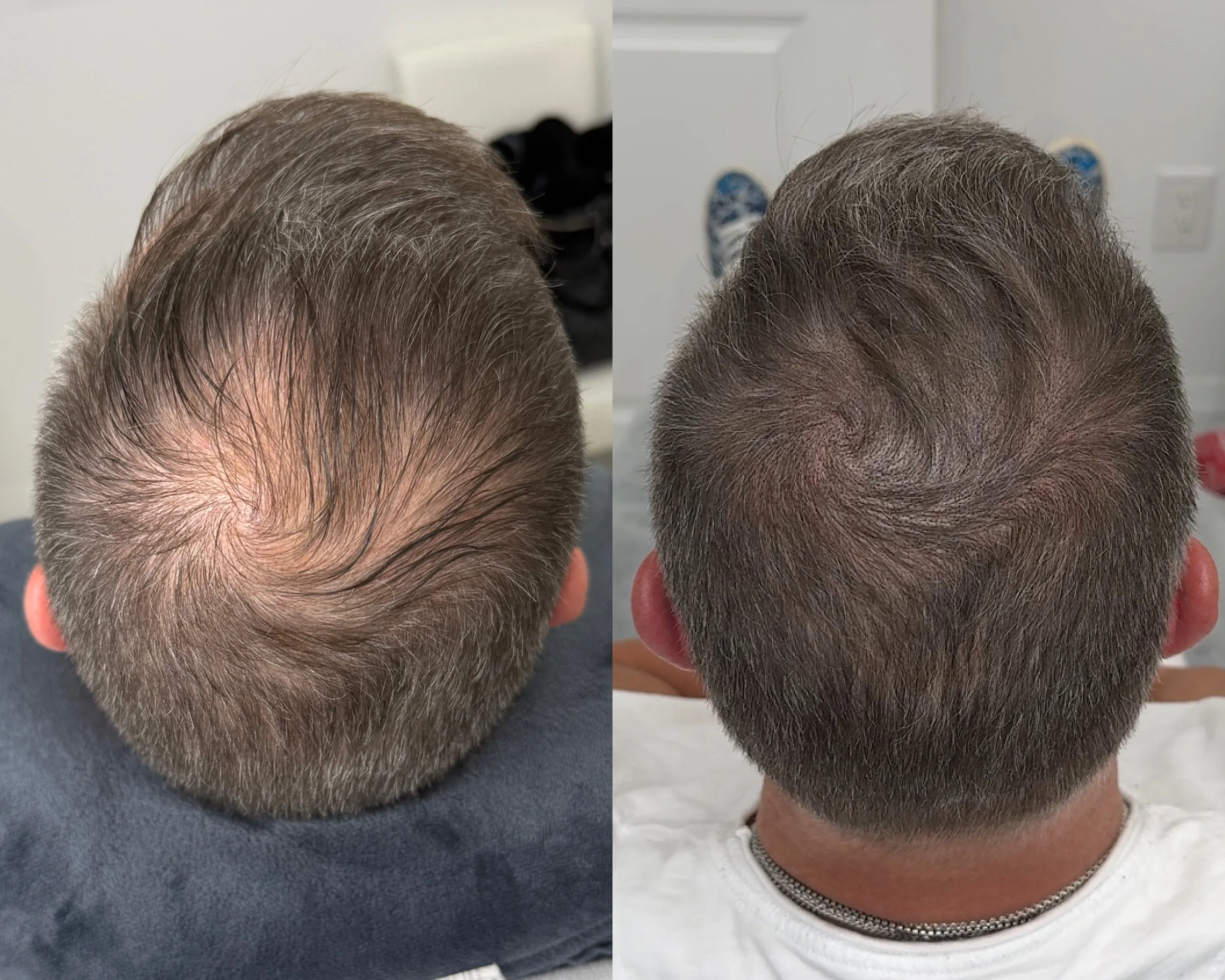 Side-by-side comparison of a person's head showing before and after hair restoration, with the before image on the left displaying thinning hair and the after image on the right showing a fuller, thicker hairstyle.