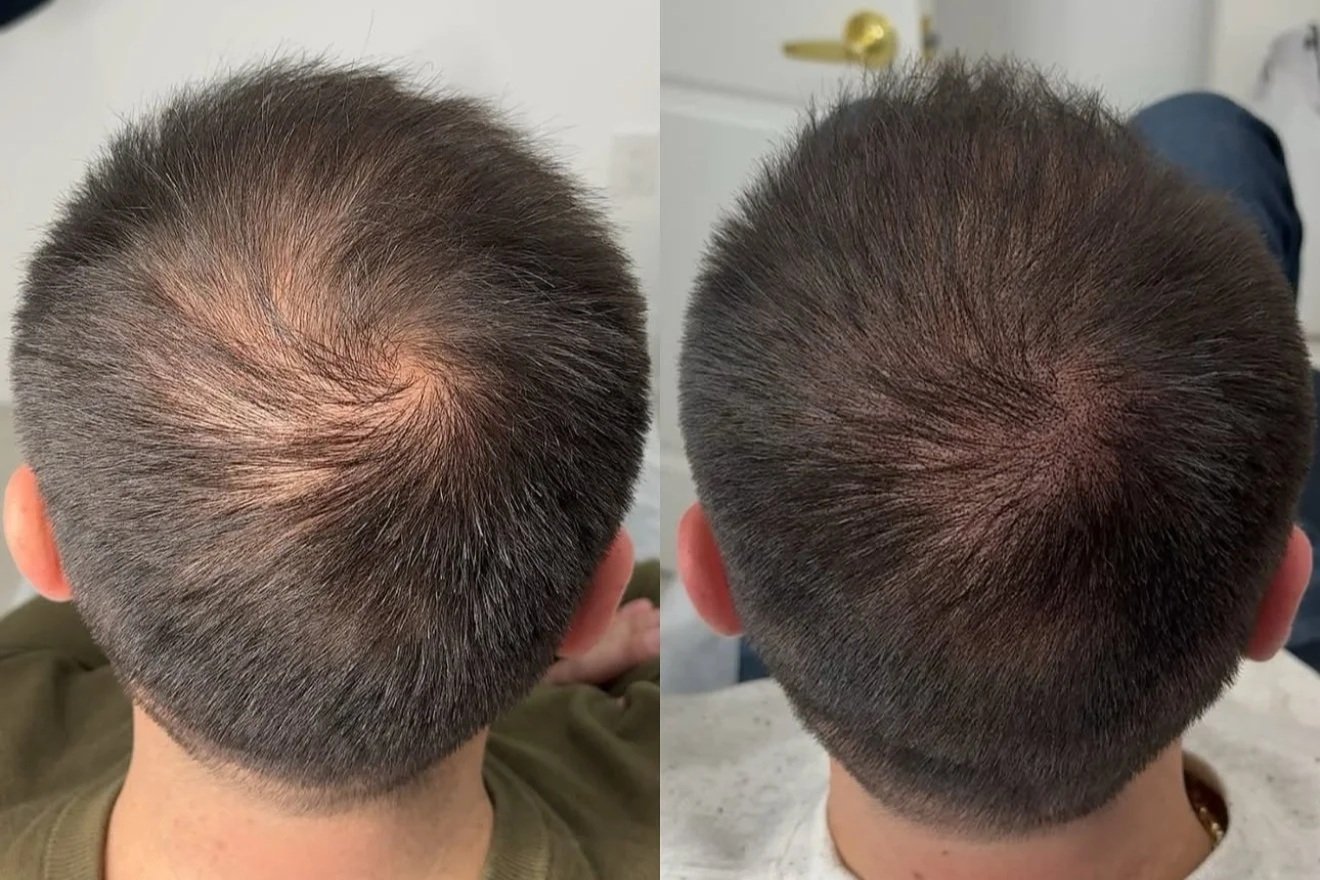 Comparison of the top view of a person's head before and after a second hair restoration session, showing improved hair density and coverage.