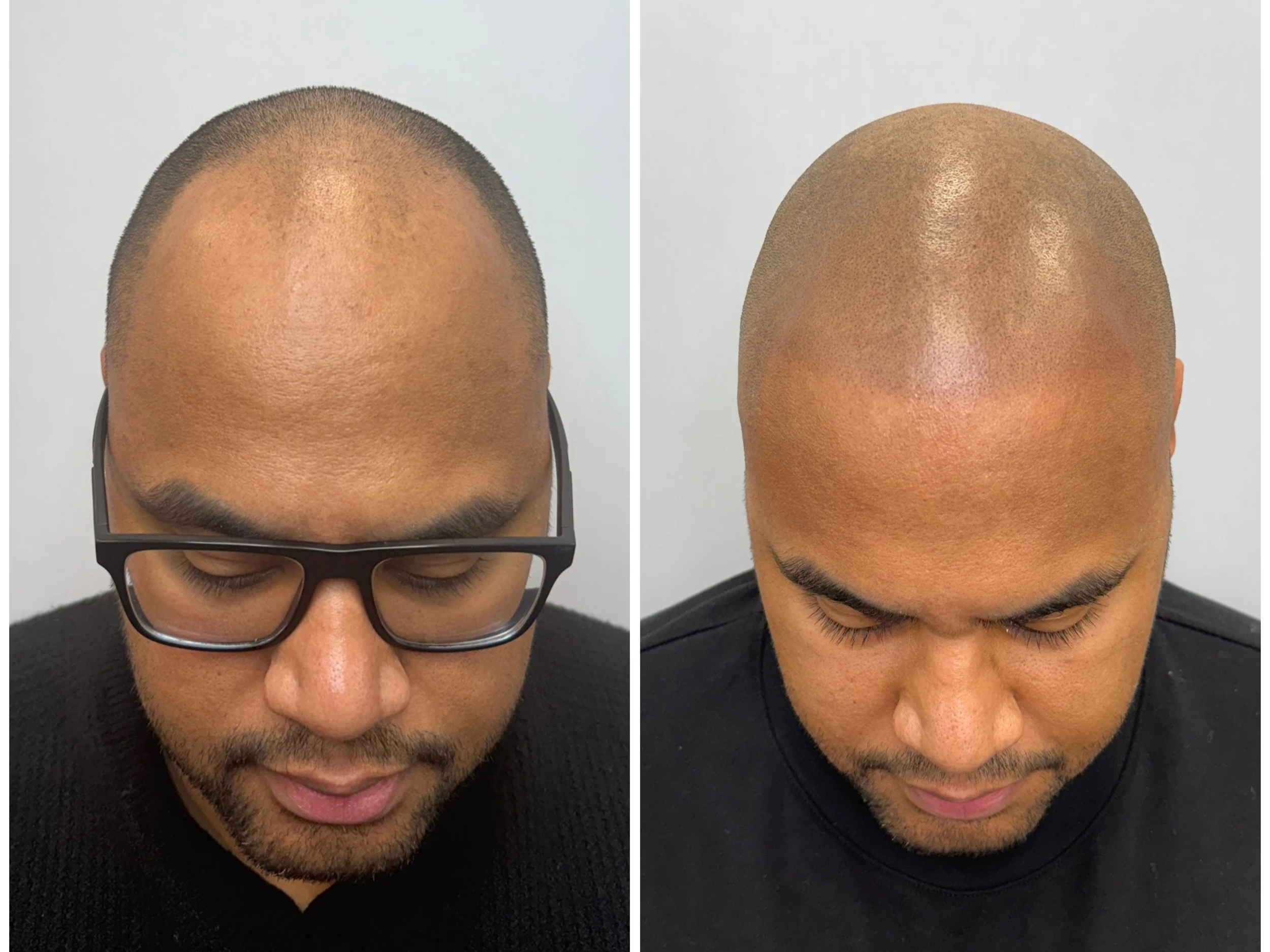 Comparison of the top of a man's head before and after a hair restoration procedure, showing fuller hair in the second image.