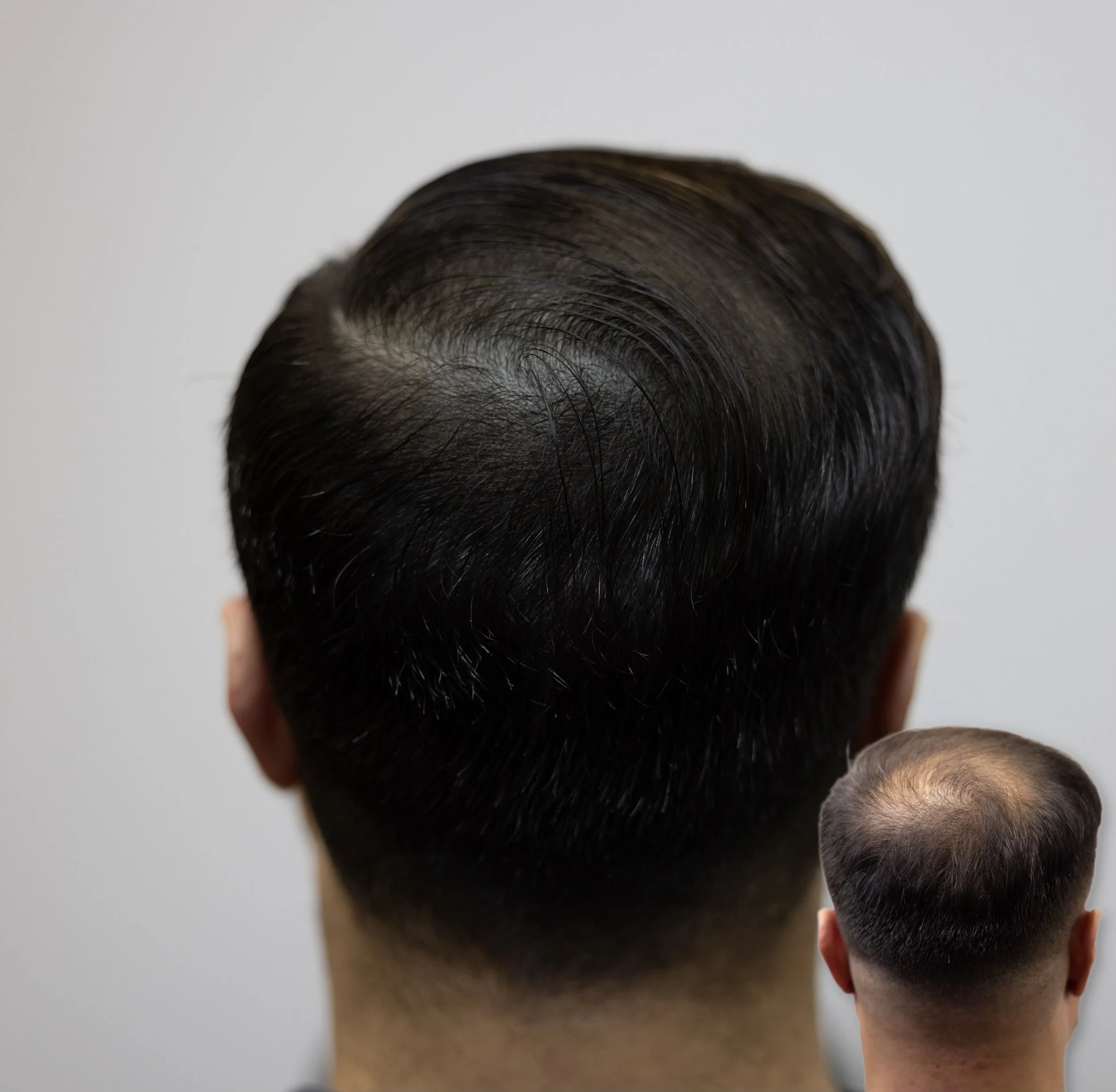 Top view of a person's dark hair, showing a fade haircut with a line design on the side, against a plain background.