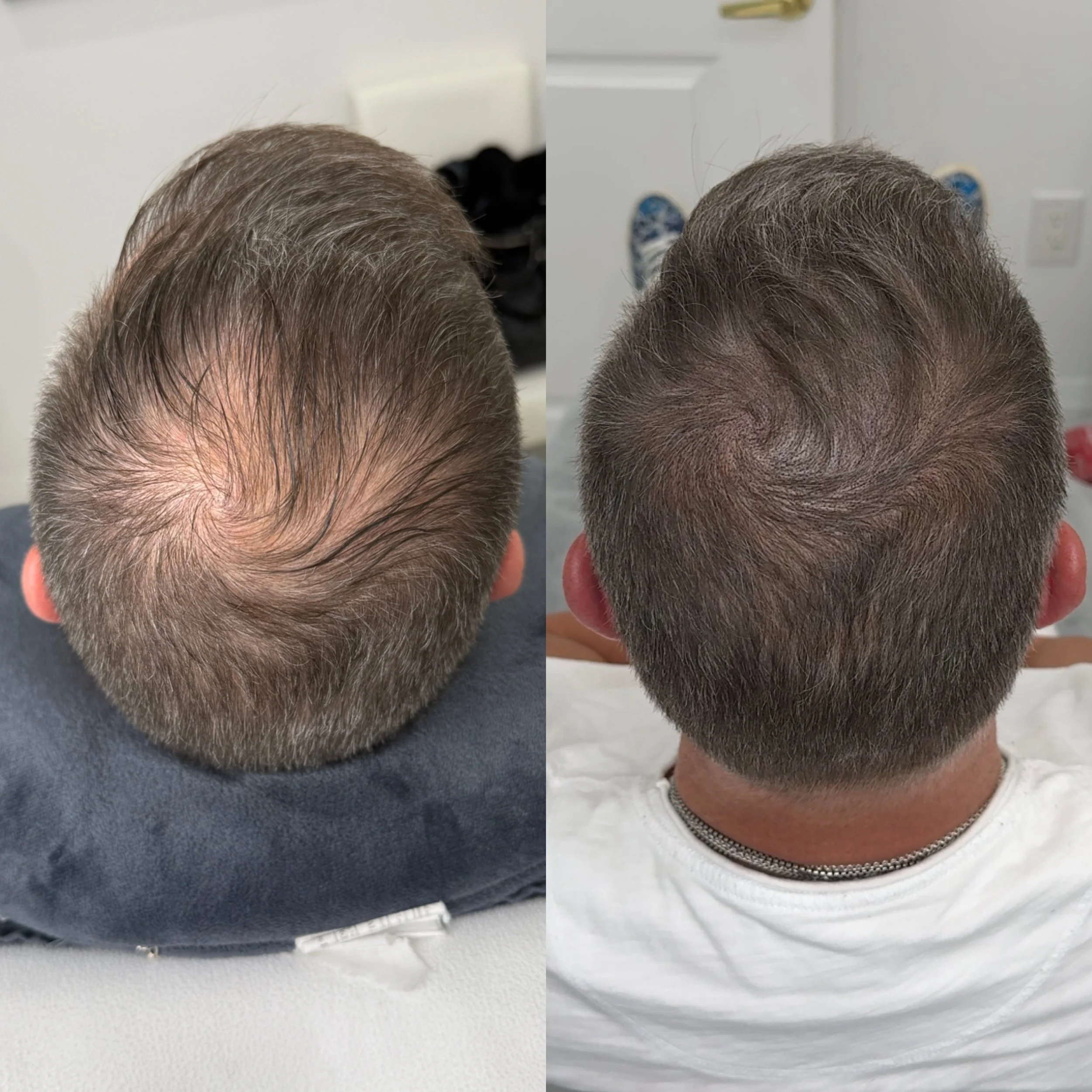 Comparison of hair before and after treatment showing improved density and thickness