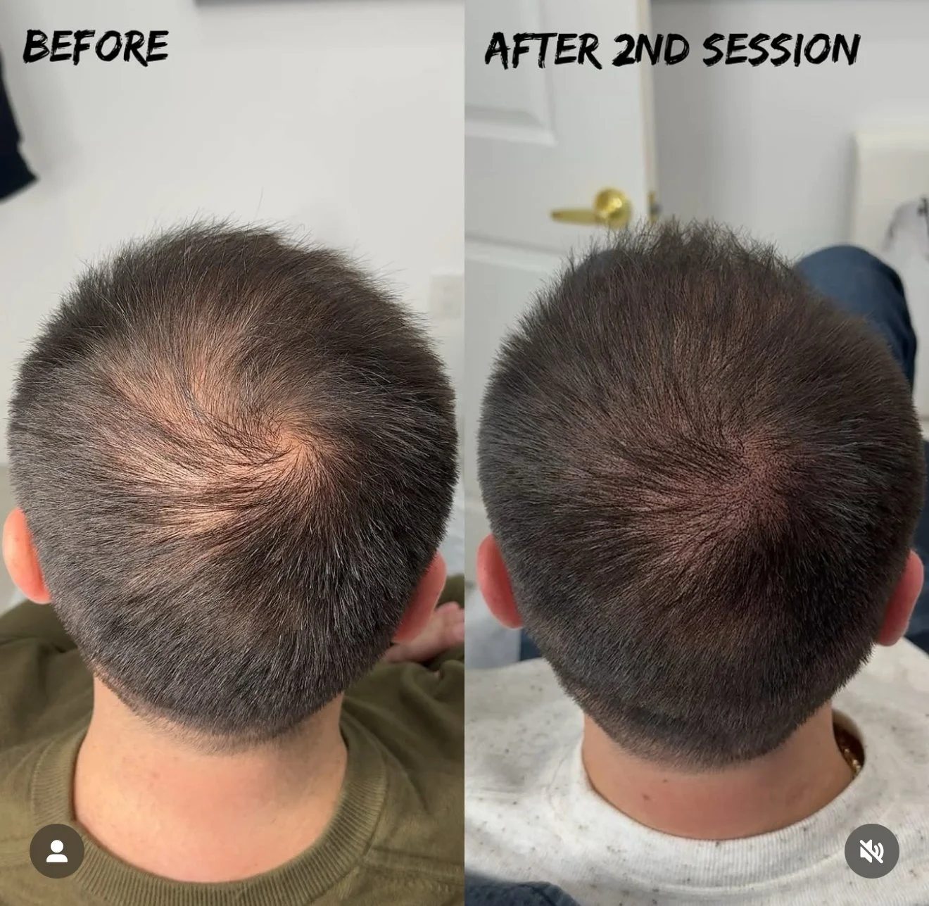 Comparison of the top view of a person's head before and after a second hair restoration session, showing improved hair density and coverage.