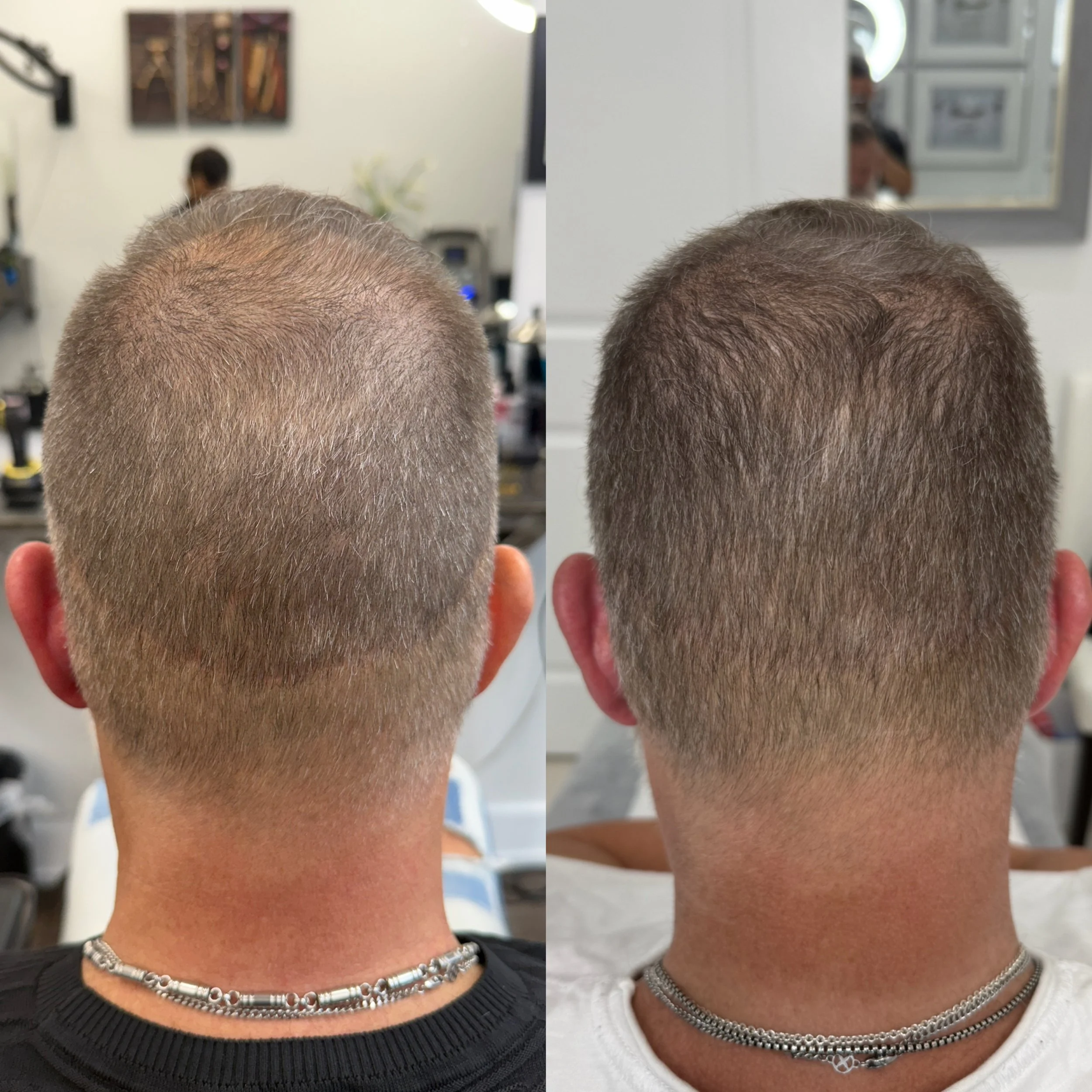 Comparison of the top of a person's head before and after hair restoration, showing thinning hair improved with new hair growth.
