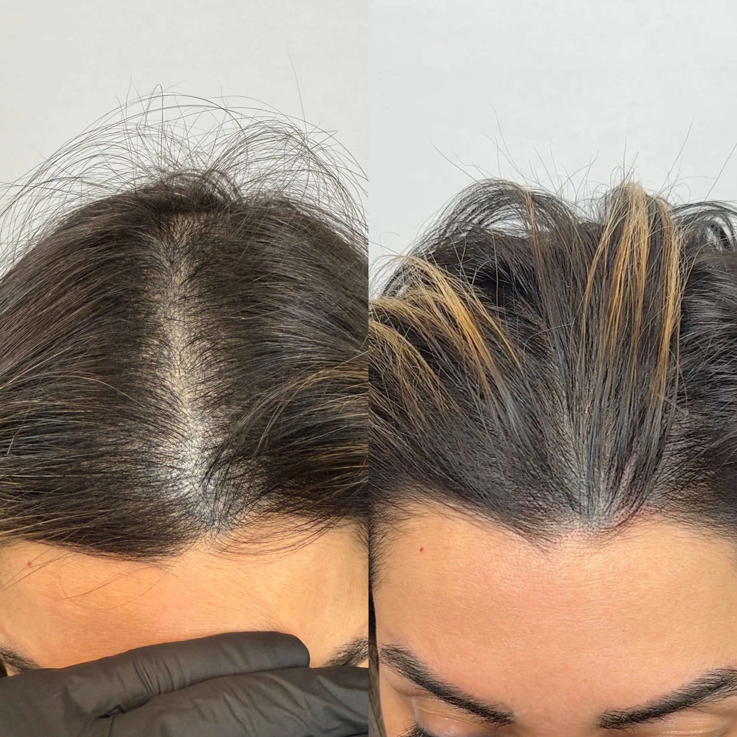 Close-up of a person's scalp and hair, showing hair thinning or hair loss, with a gloved finger touching the scalp.