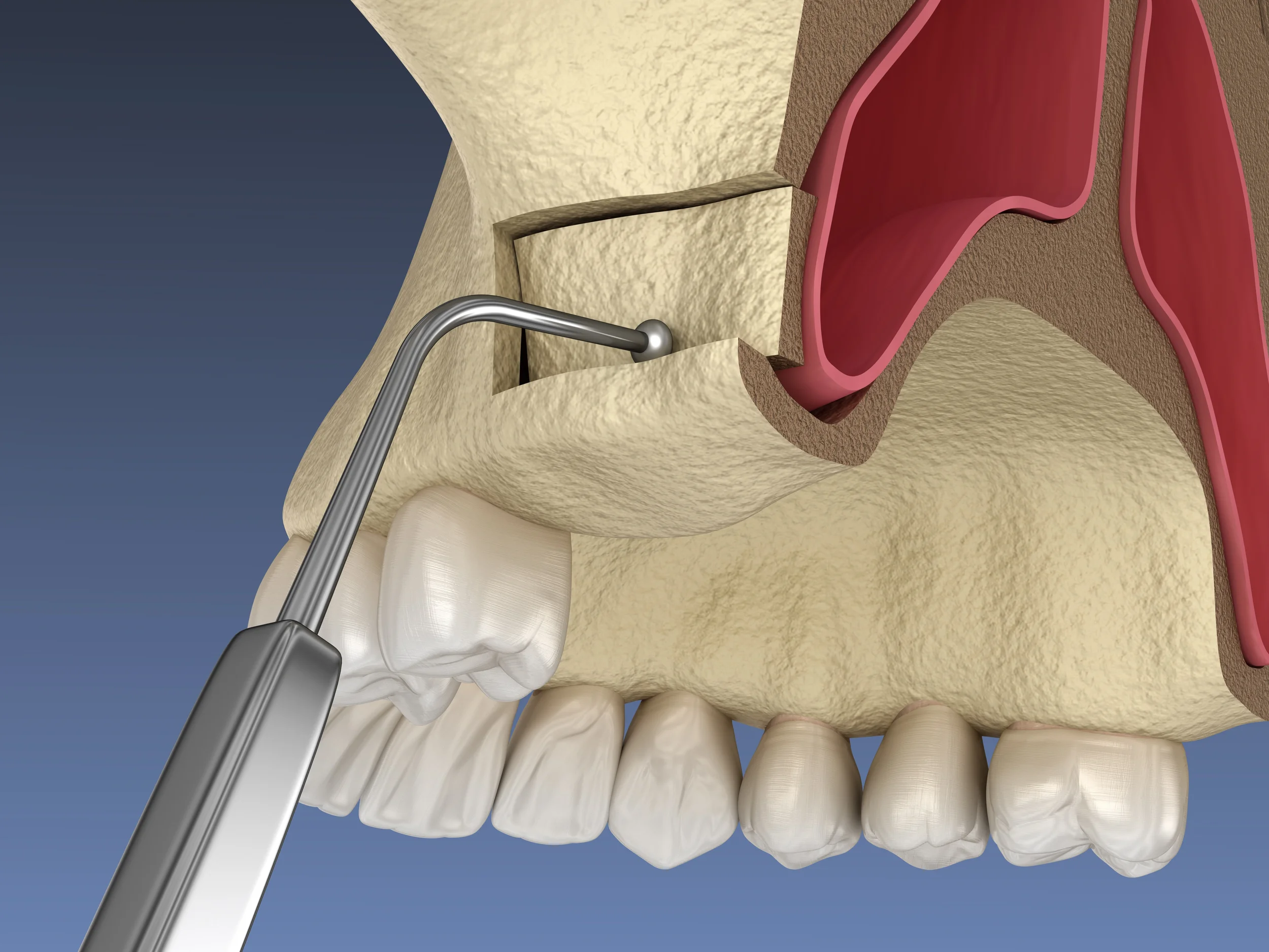 Internal Sinus Lift Procedure for Dental Implant Bone Support