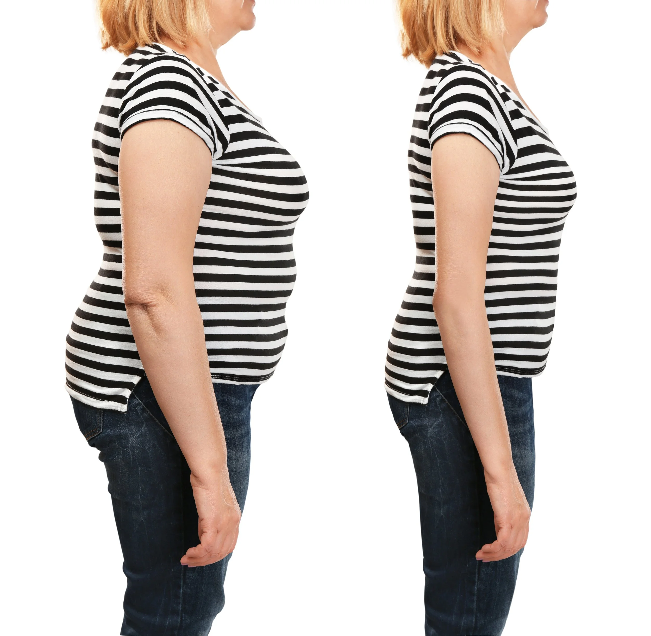 Before and After 360 VASER Liposuction Patient Result in Izmir Turkey