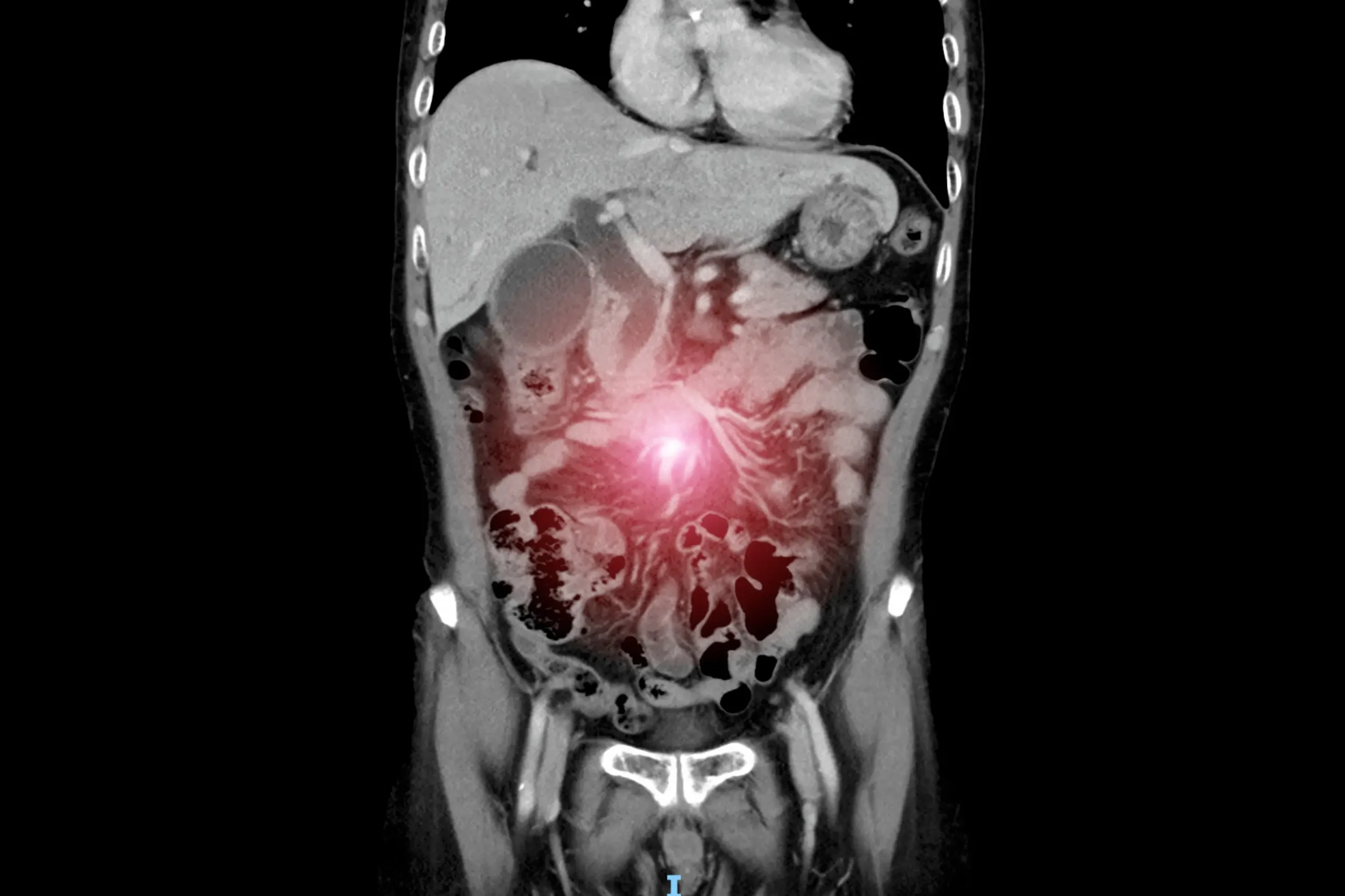 radiation-enteritis-ileus-surgery-turkey