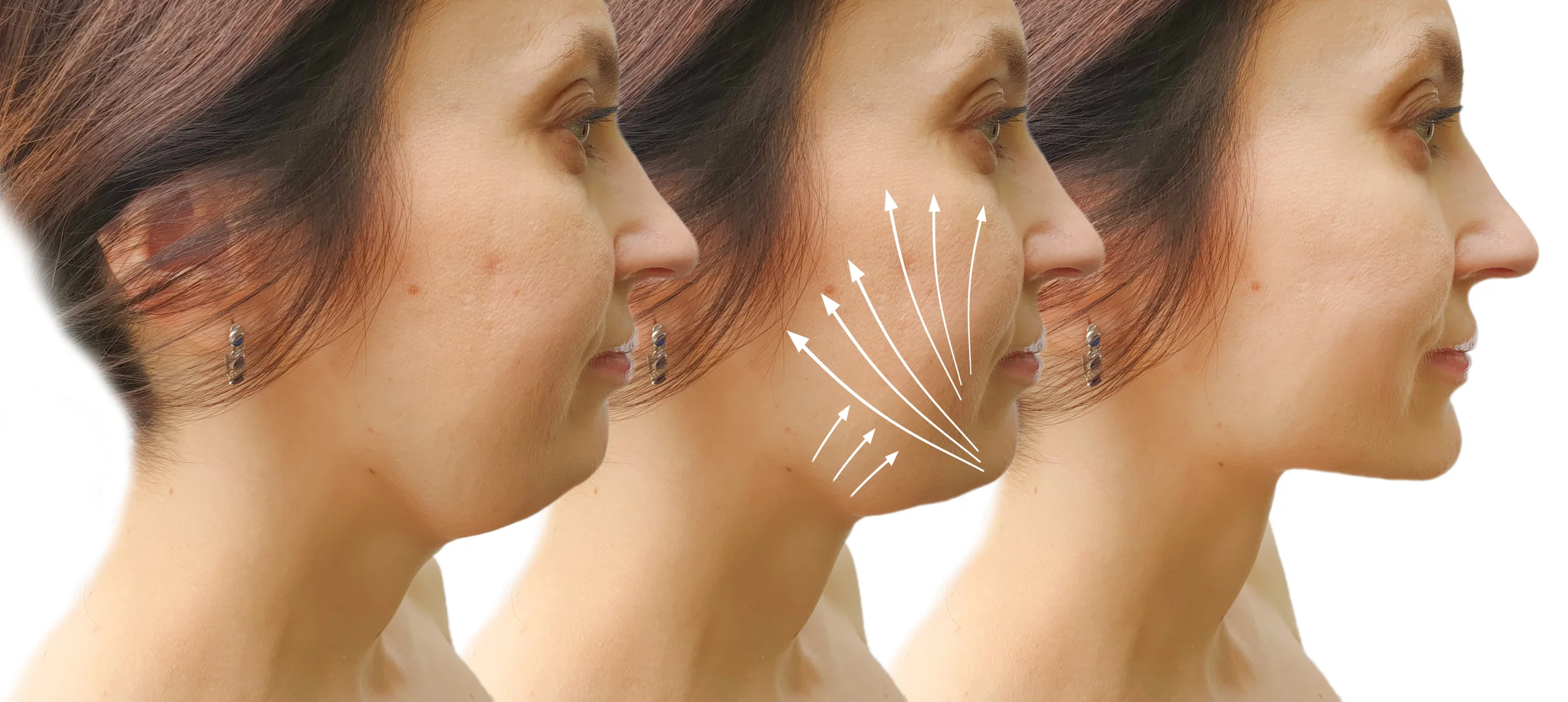 neck-lift-jawline-contouring-turkey