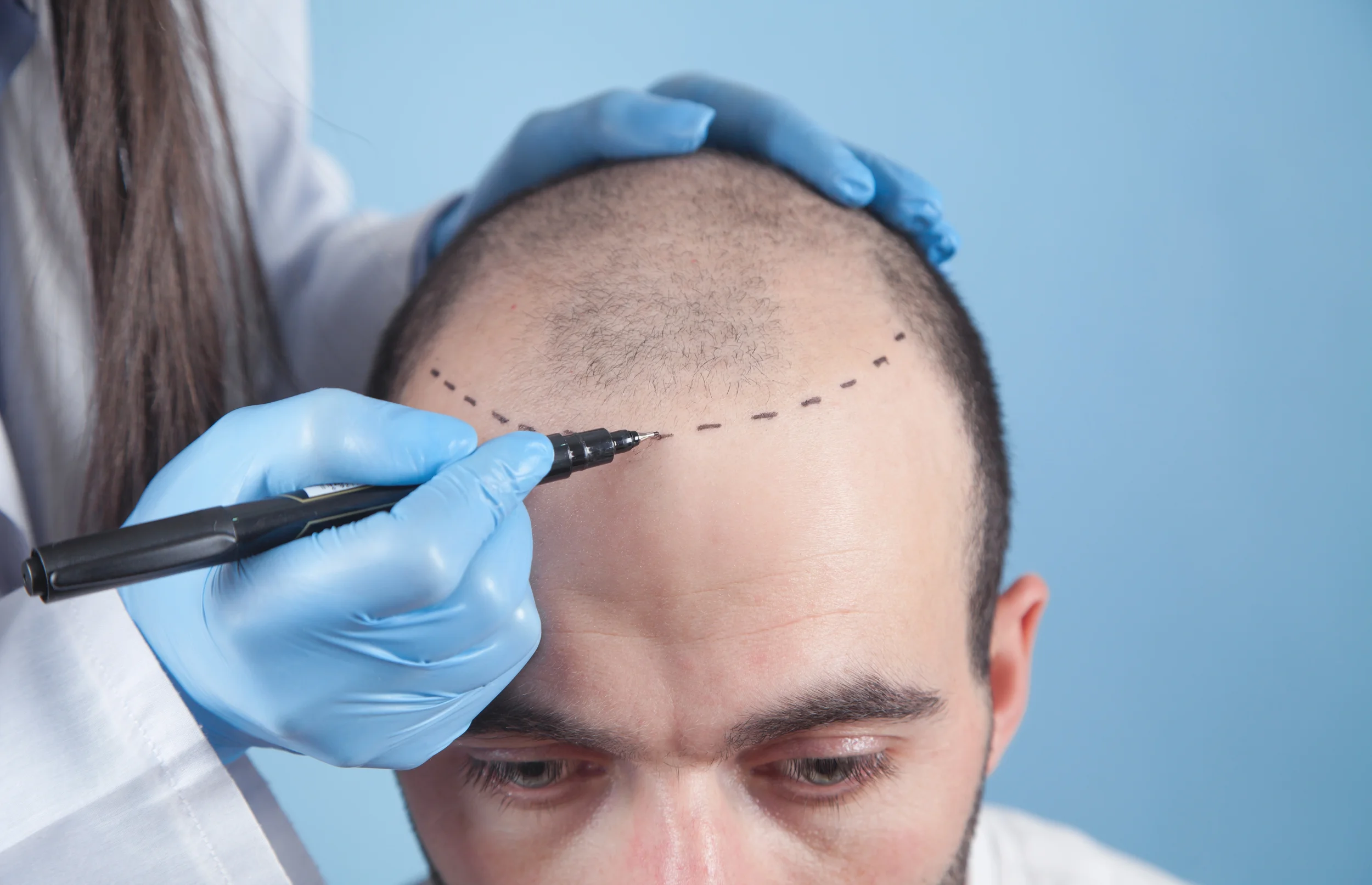 hair-transplant-fue-dhi-results-turkey