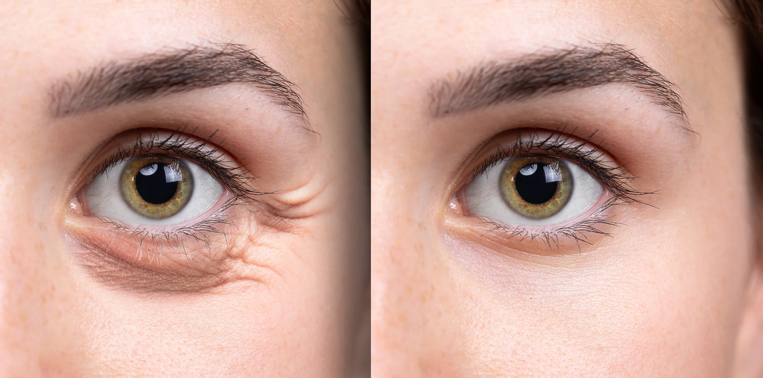Under Eye Tear Trough Filler Treatment for Dark Circles Result