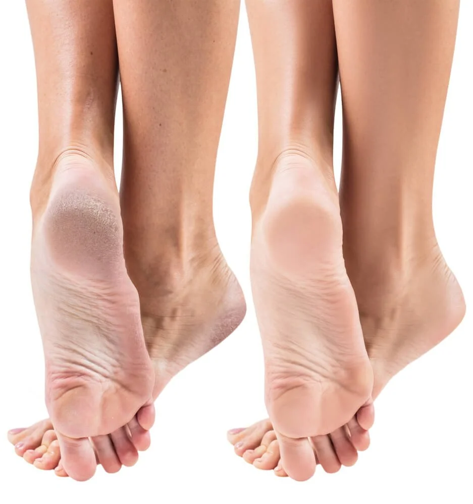 foot fungus, athletes foot treatment, nyc podiatrist