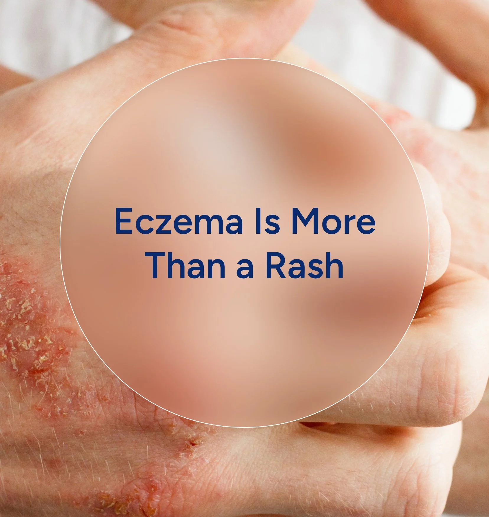 Close-up of a human hands and fingers with dry, cracked, and irritated skin, with a rounded overlay containing the text "Eczema Is More Than a Rash".