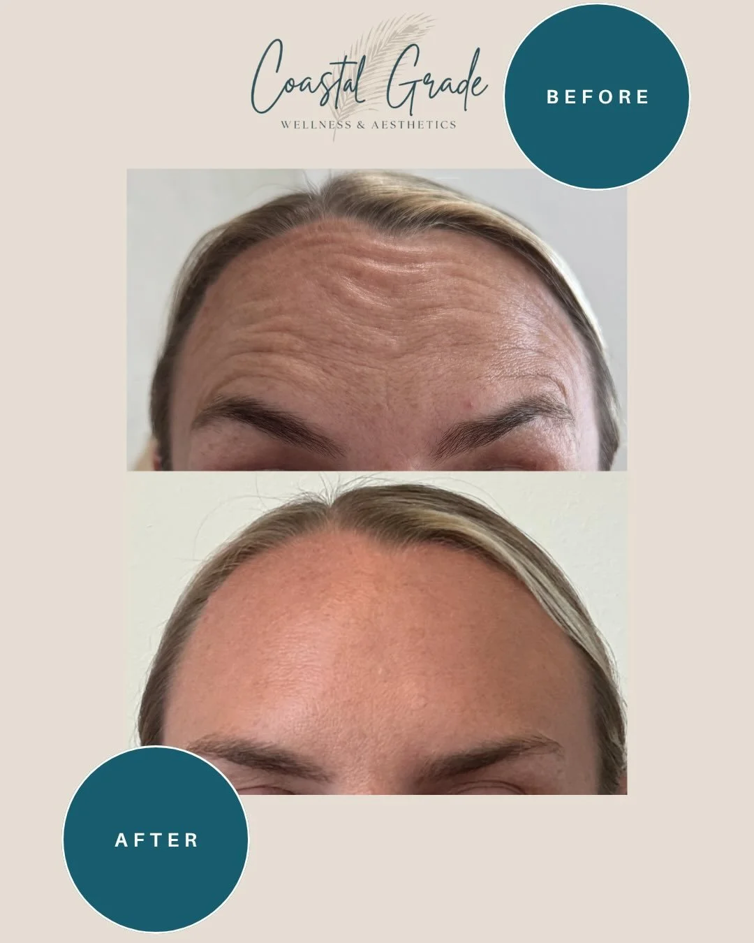 We love a little Tox magic ✨💉

We treated this patient with Jeuveau, aka &ldquo;Newtox&rdquo;. Results started kicking in within TWO days! &amp; Lets just say these before and after speak for themselves 👏🏼
Smoother, softer lines while keeping a na