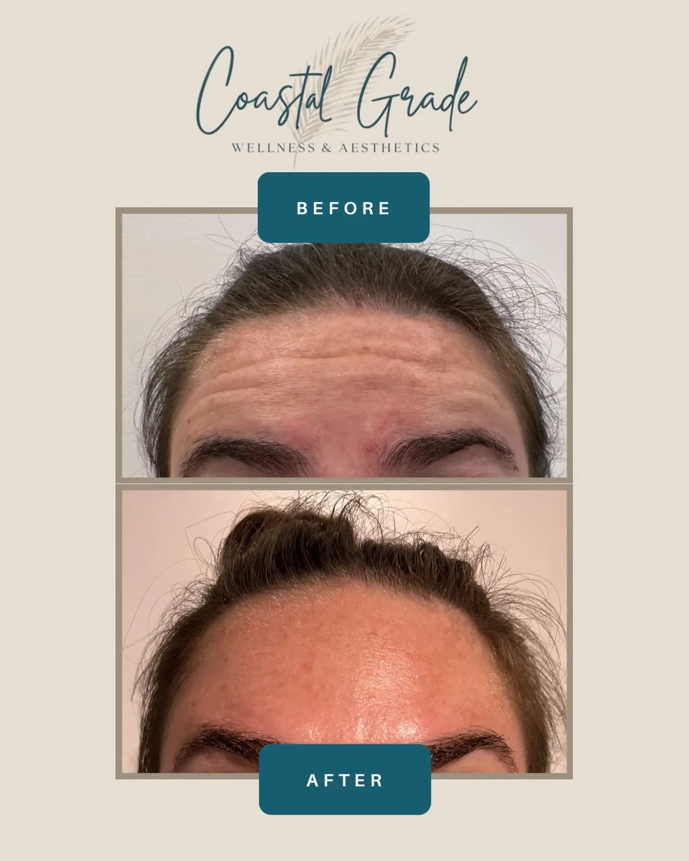 ✨ Smooth, Refreshed, and still YOU ✨

These results were achieved with Jeuveau to help soften those forehead lines and create a smoother, more youthful appearance. 

Are you ready for a natural, refreshed look? 
Send us a DM or text us at 941-335-950