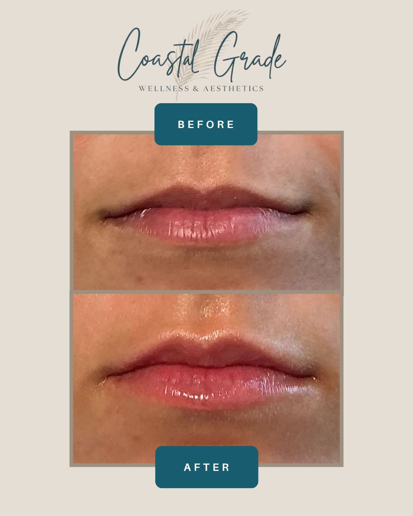 ✨EARLY LAUNCH ANNOUNCEMENT!!✨
We&rsquo;re thrilled to share that our books are officially OPEN for lip filler consultations and appointments at Coastal Grade! 💋 If you&rsquo;ve been dreaming of those gorgeous, natural looking lips, now&rsquo;s your 