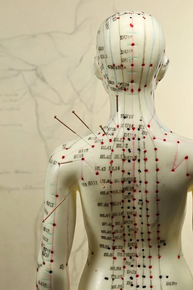A human anatomical model showing acupuncture points and meridian lines on the back, neck, shoulder, and arm with multiple acupuncture needles inserted.