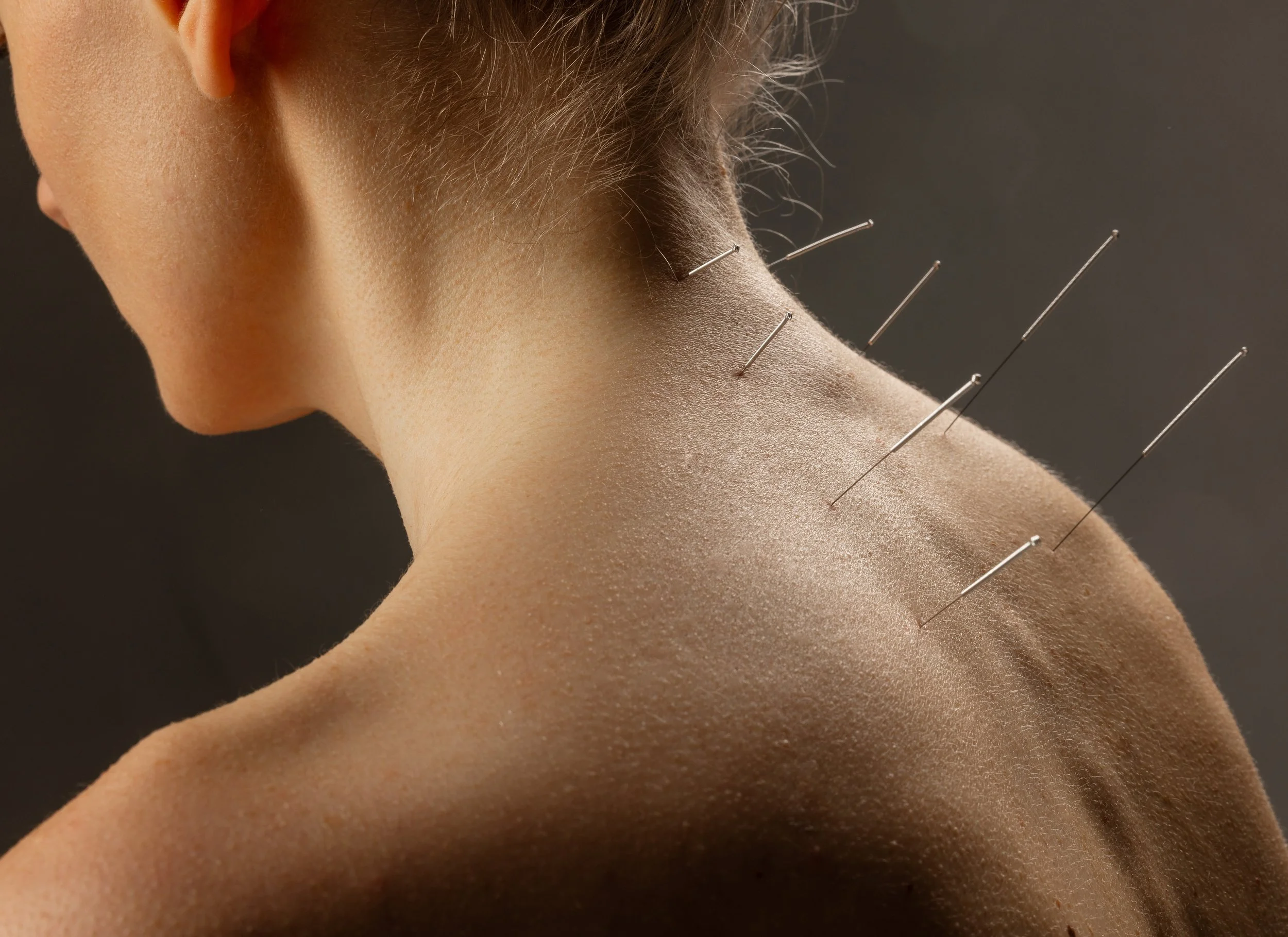 A person undergoing acupuncture therapy on the back of their neck and shoulder, with multiple acupuncture needles inserted.