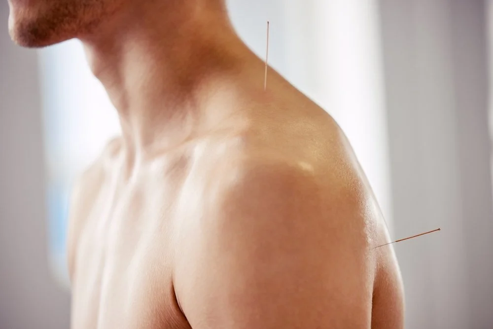 A person receiving acupuncture with several needles inserted into their shoulder and neck area.