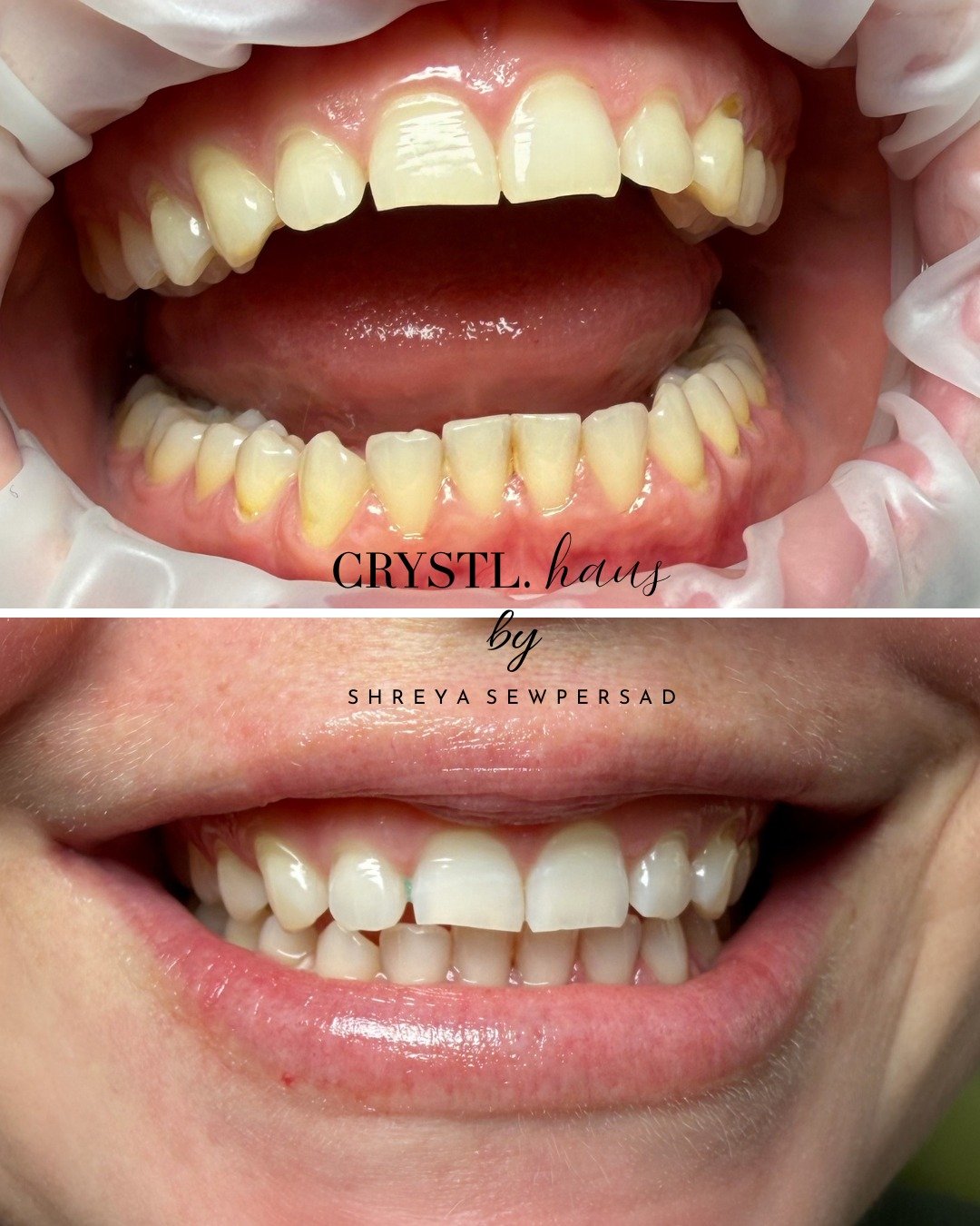 Swipe right to clean &amp; whiten. Opalescence Boost gel is chemically activated and lifts stains in under an hour!
Crystl Clear Package: visit www.crystlhaus.com for more information.
Matric Dance coming up? Book now for 15% off.