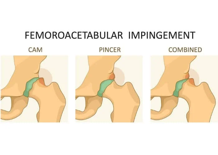 hip impingement